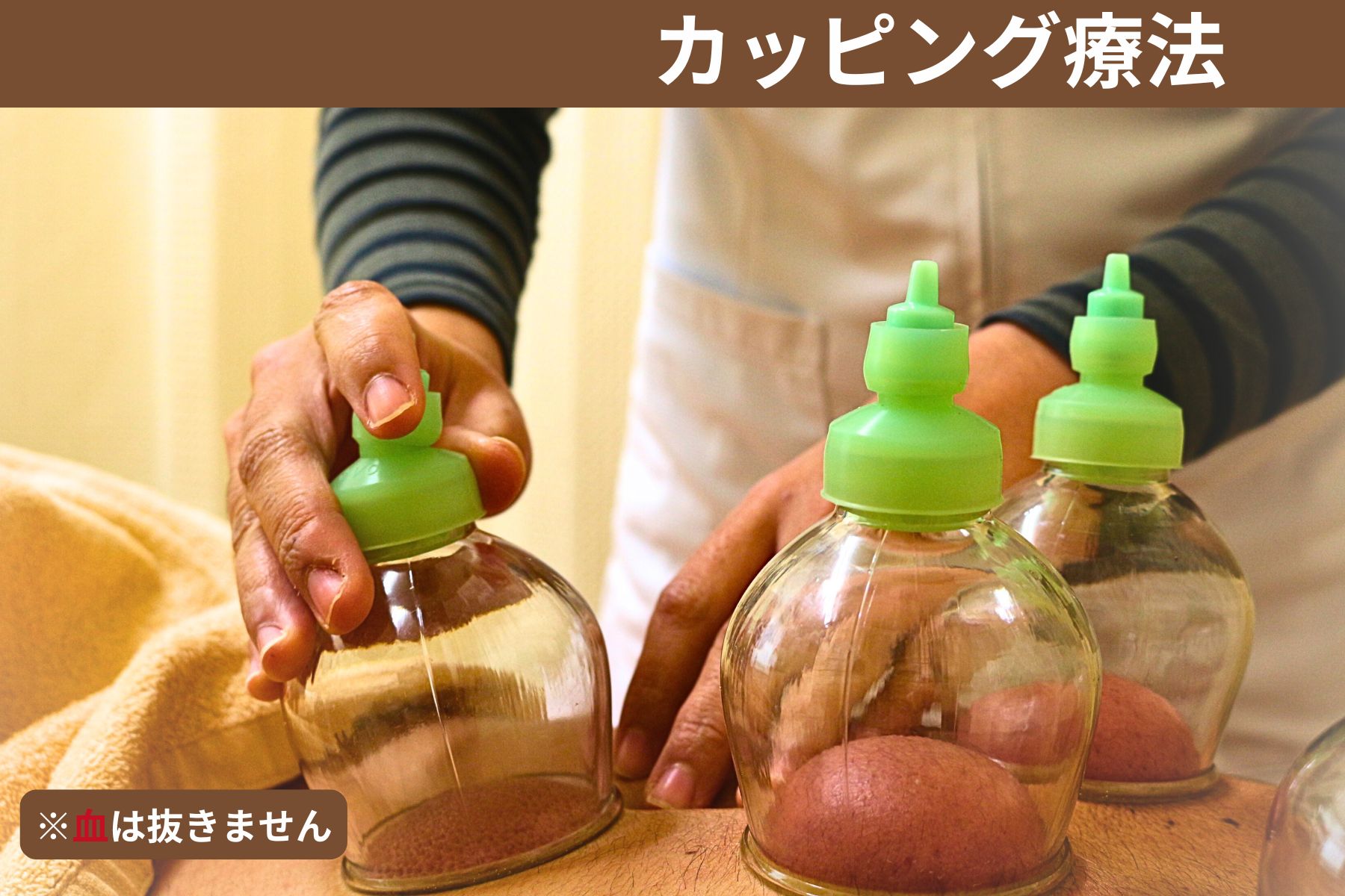 沖縄県那覇市首里スマイル鍼灸整骨院　本院 【カッピング】初めての方でも安心して受けられます。※血は抜かないです。のメニュー画像