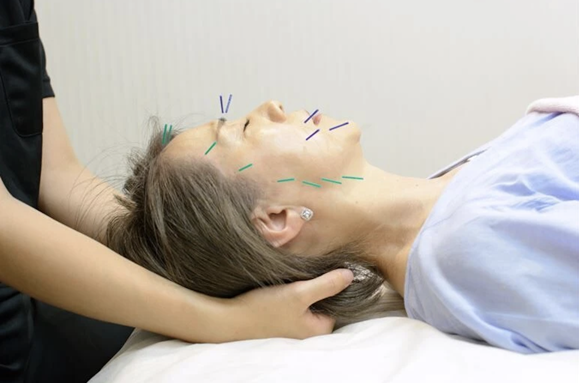 Gen鍼灸マッサージ めじろ台 美容鍼30分(電気無し)のメニュー画像