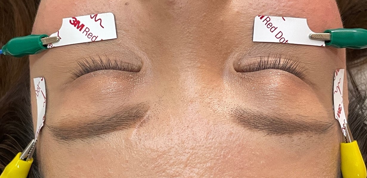 鍼灸マッサージ・美容鍼・ダイエット　藤井治療院 美容鍼オプション　目元の電気のメニュー画像