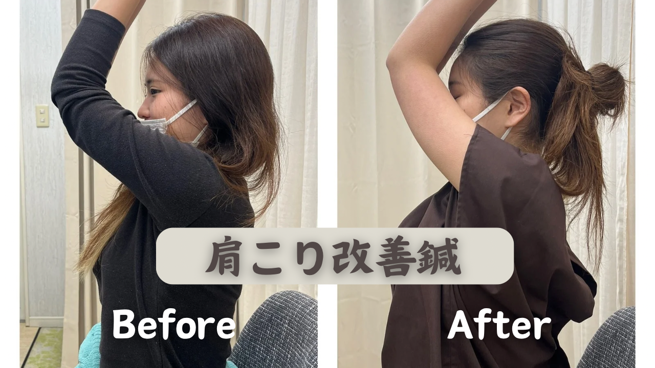 鍼灸院はりエイト 【継続】肩こり改善のメニュー画像