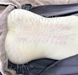 ルート鍼治療【高知】もりさわ治療院　与力町治療室　ＴＯＳＡＫＡ　 ルート鍼治療２枠のメニュー画像