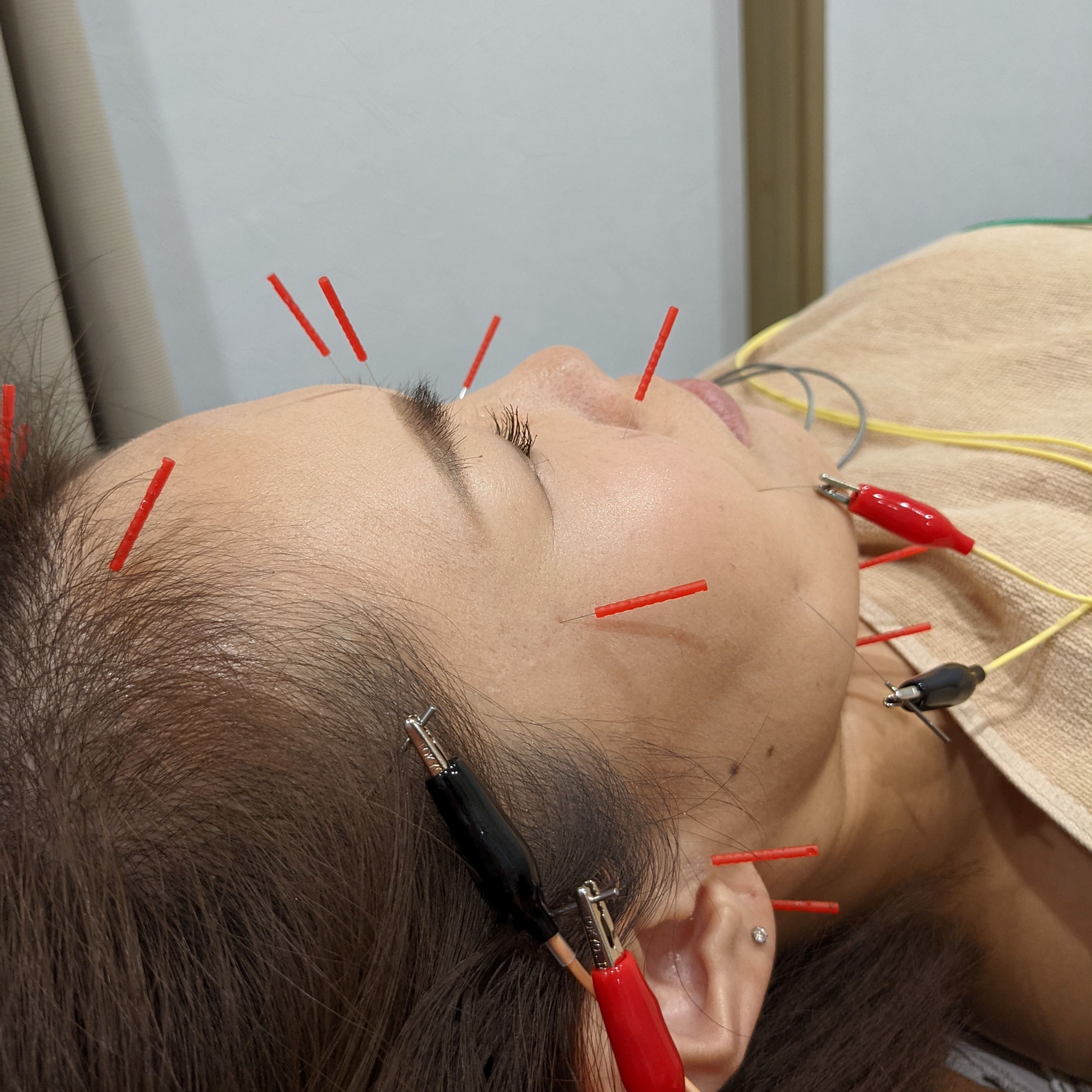 みのり鍼灸整骨院｜痛み＆慢性痛｜リウマチ｜東三国 美容鍼（お顔のみ）のメニュー画像