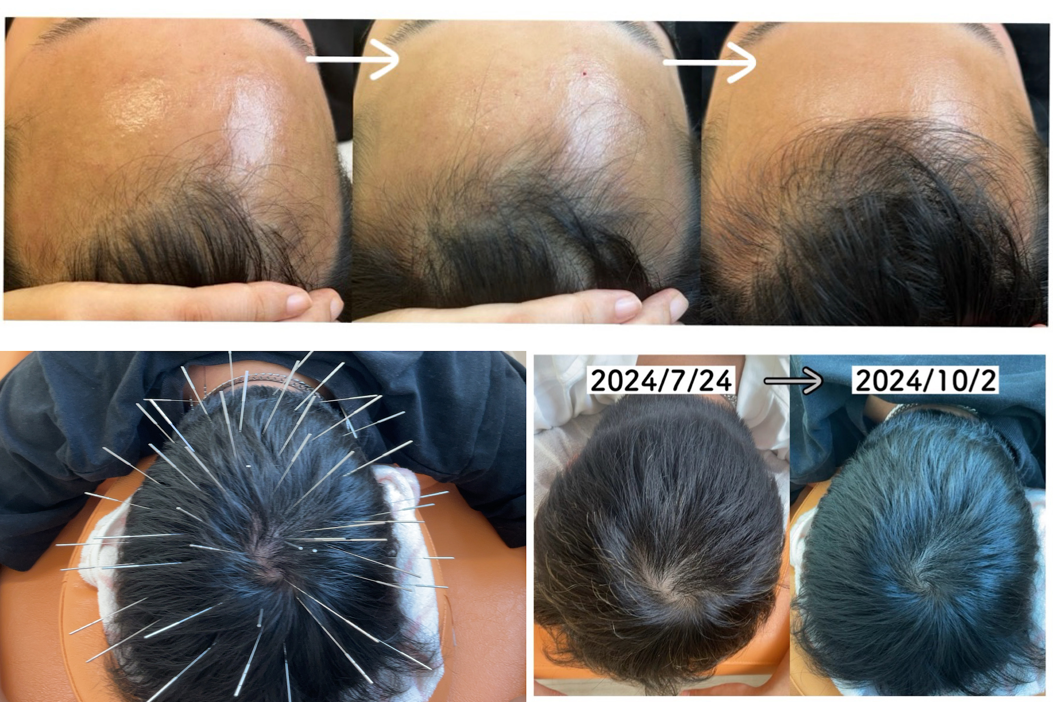みやけ鍼灸院（ルート治療） 薄毛治療　単品のメニュー画像