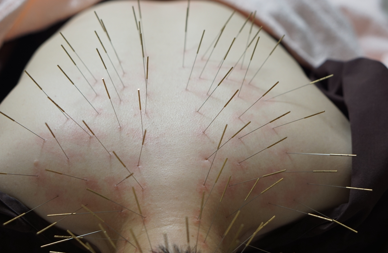 ハリ・イヅミ ルート治療90分のメニュー画像