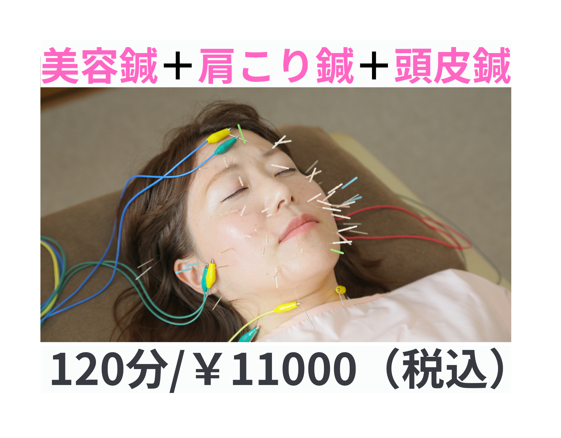 みずのえ鍼灸院 美容鍼（EMS通電パルス鍼付）＋肩こり鍼＋頭皮鍼（刺激量強め）のメニュー画像
