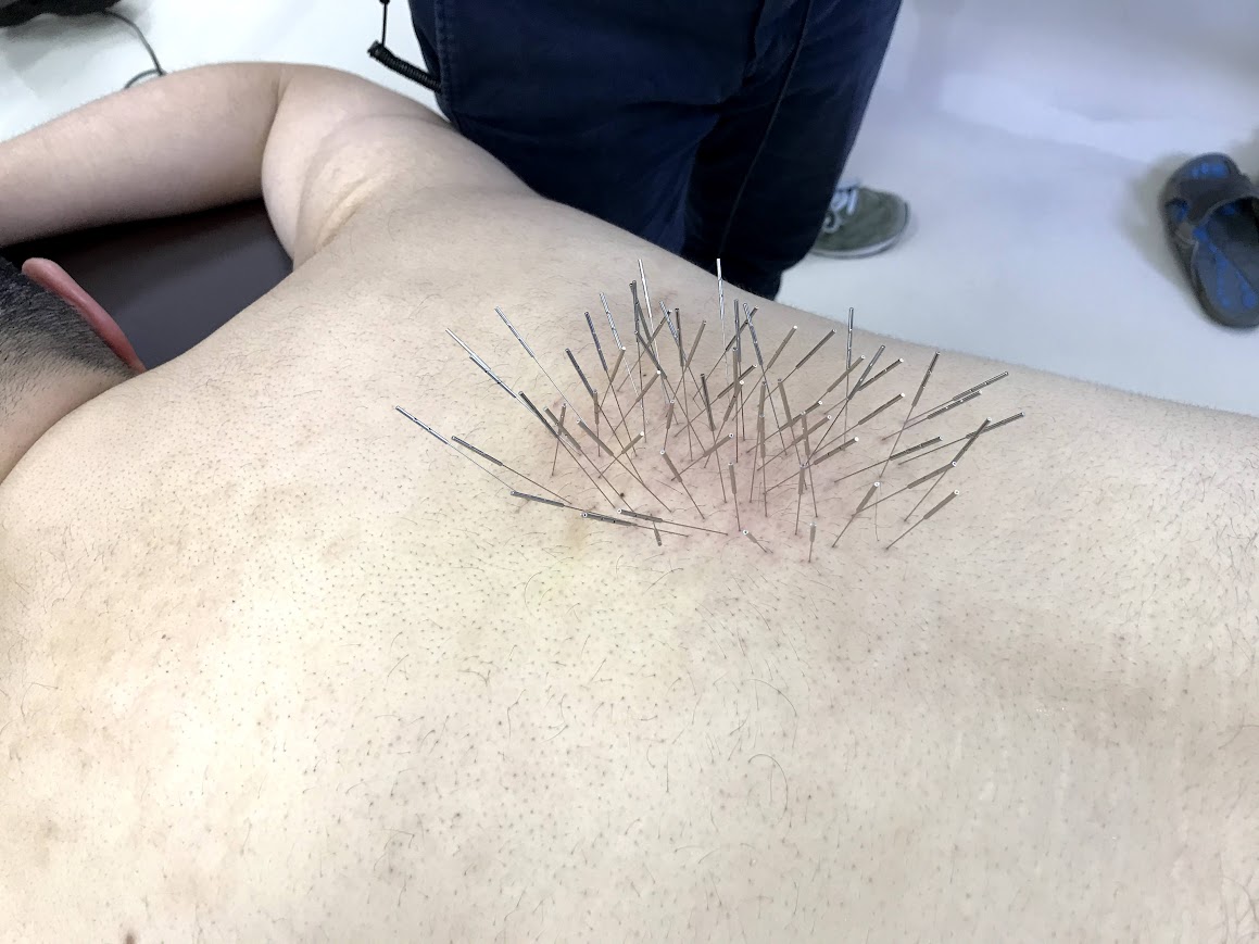 Owl治療室 難治鍼施術（ルート鍼）のメニュー画像