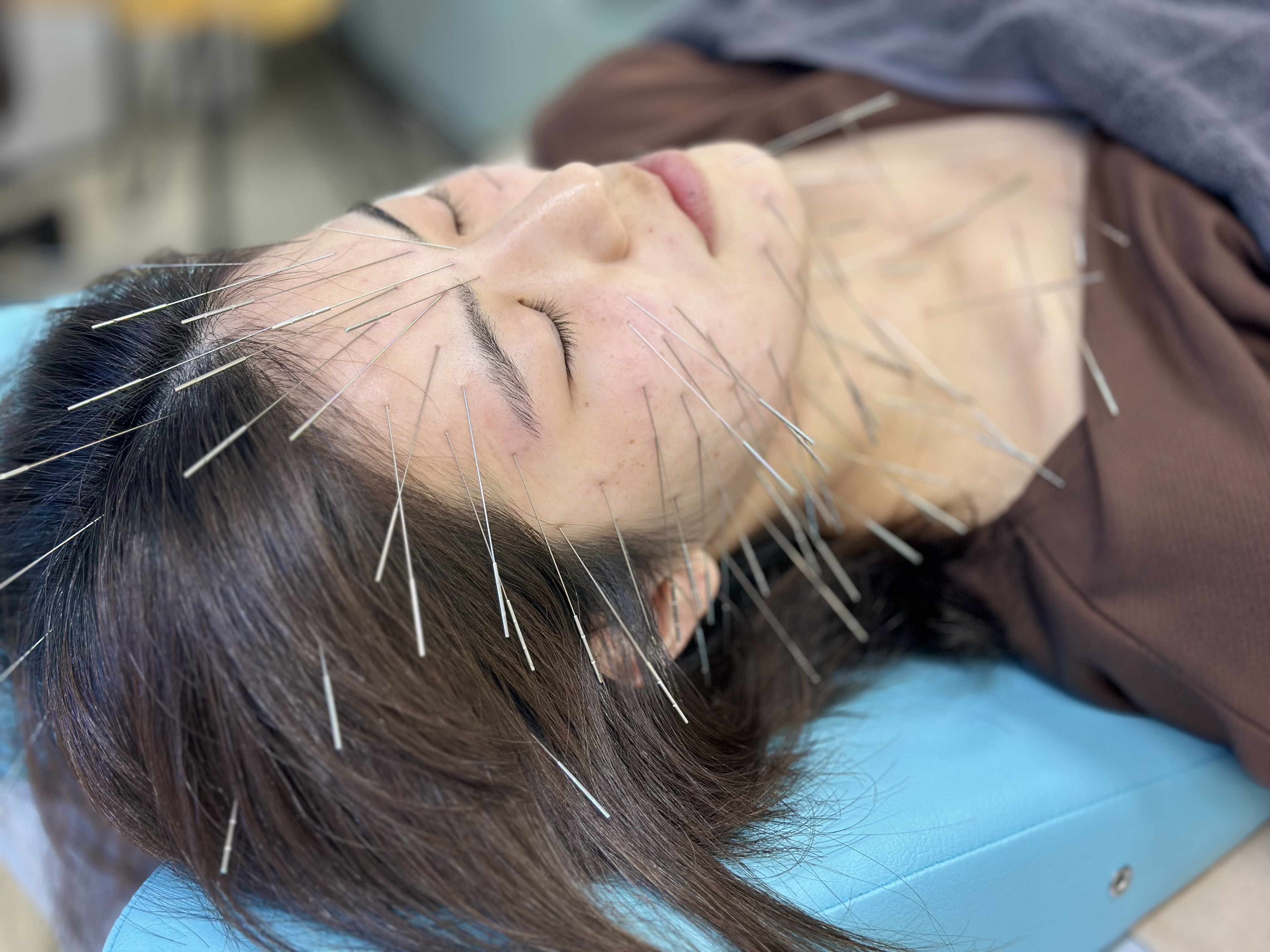 美身堂えいち鍼灸院 〜ルート治療・美容鍼〜 鬼美容鍼のメニュー画像