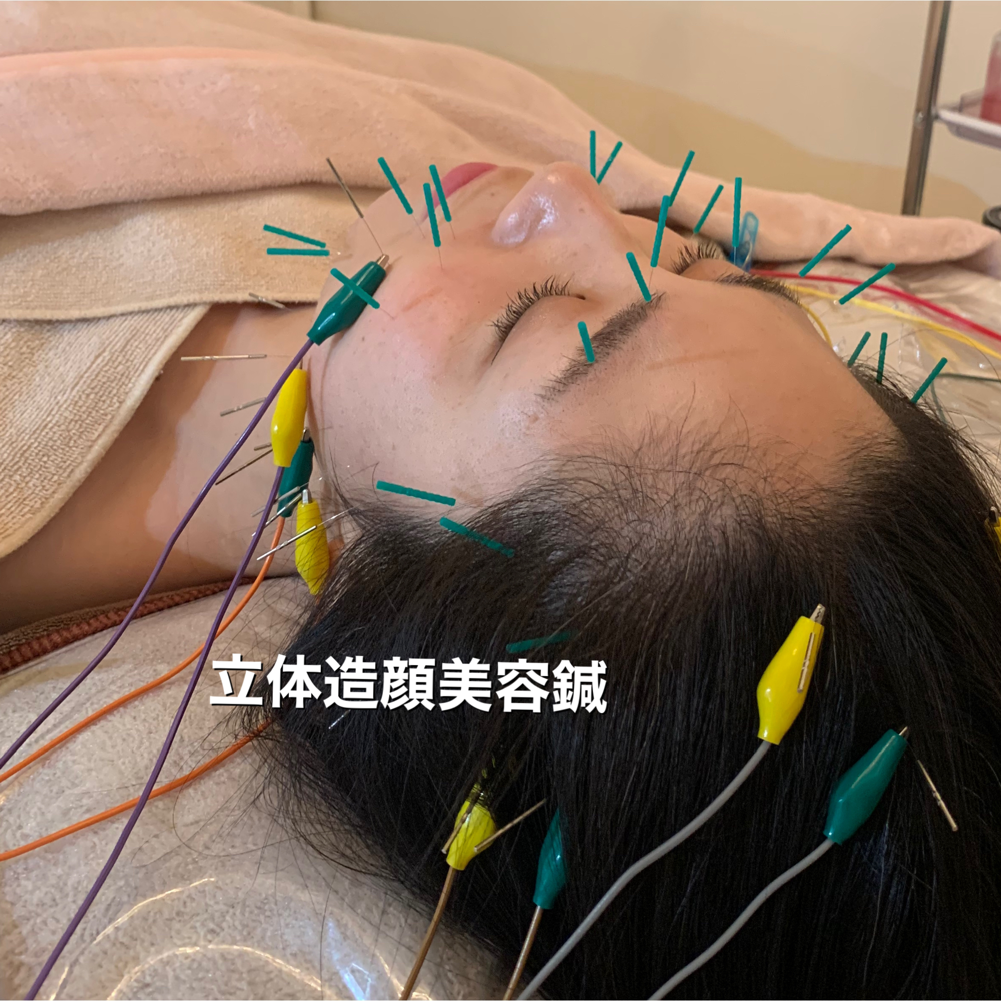 Accu:Sell（youkonurse＆暢子美容鍼灸） 新規の方　立体造顔美容鍼のメニュー画像