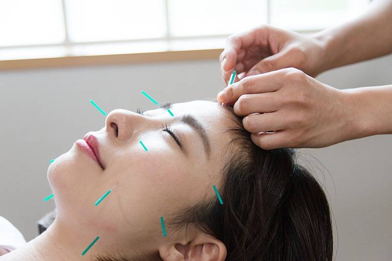 スカイブルー鍼灸接骨院 【新規限定】美容鍼(フェイシャルでお悩みの方におすすめ)のメニュー画像