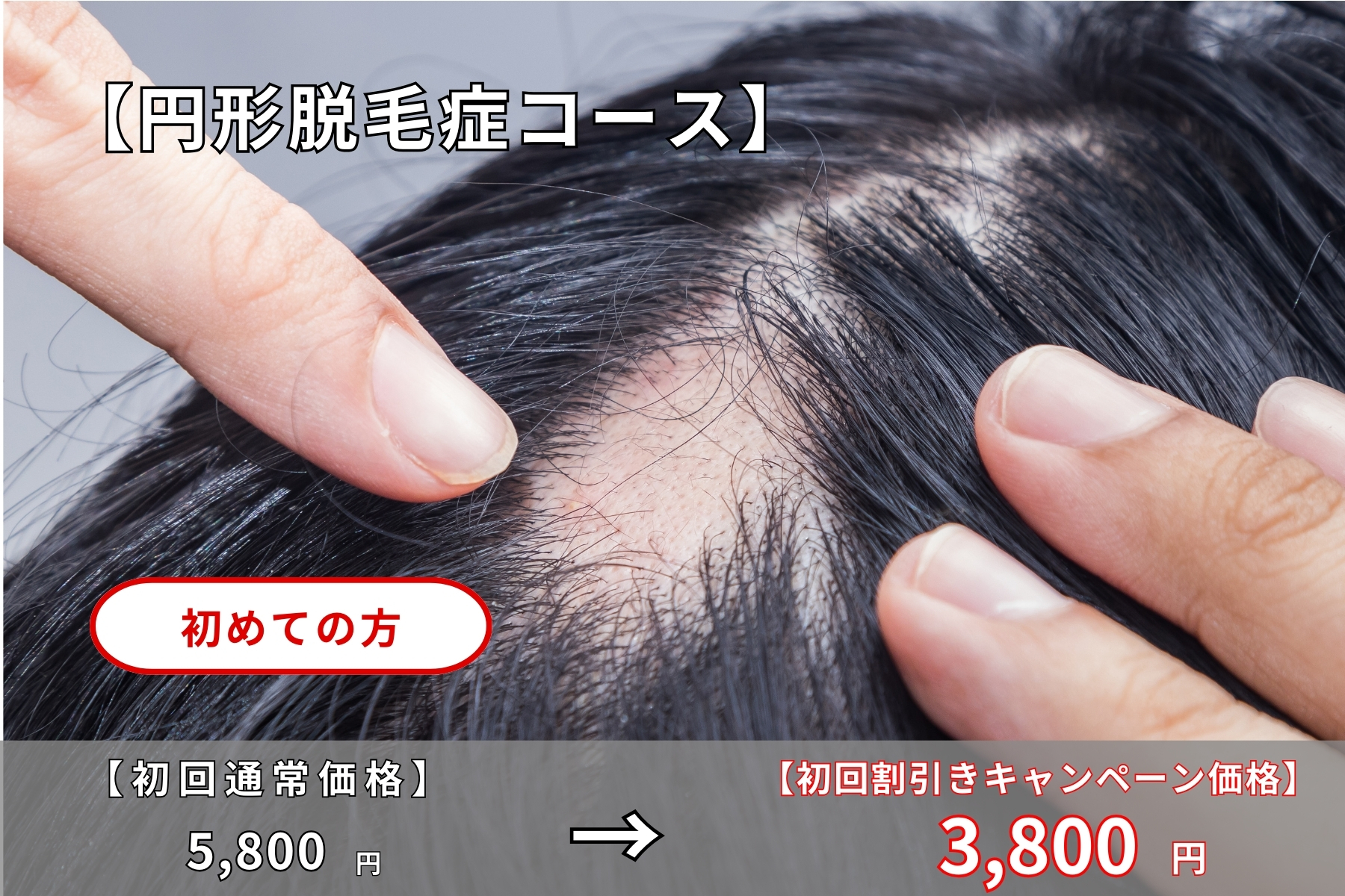 沖縄県那覇市首里スマイル鍼灸整骨院　本院 相談依頼急増中！円形脱毛症治療｜実績ある国家資格者が施術する鍼灸治療。原因はストレスや環境の変化から始まる脱毛現象。リーズナブルに長期的に通院しやすい価格。のメニュー画像