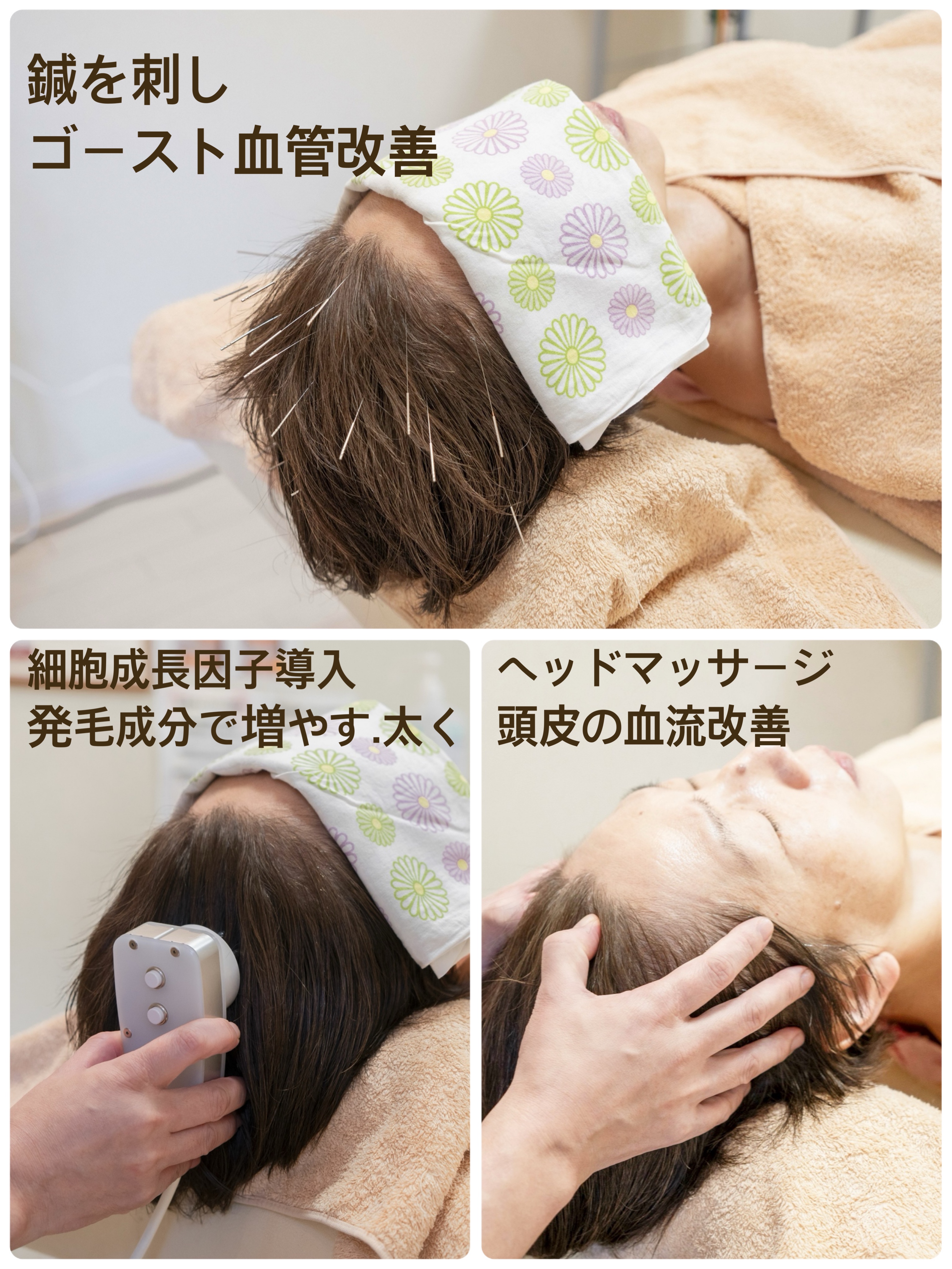 薄毛鍼　本気で向き合う　いくほ治療院 2回目以降　薄毛治療　新規の方は停止してますのメニュー画像