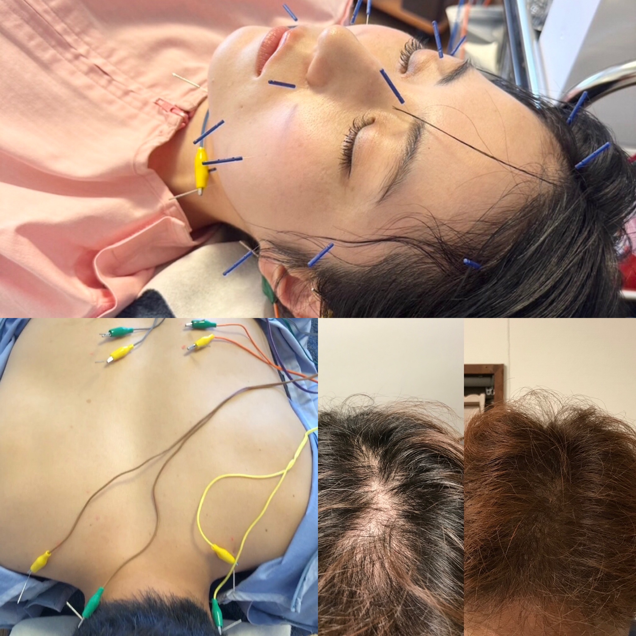 中野区野方鍼灸院のむち鍼 +鍼 しっかり(自律神経の鍼か美容鍼か体の鍼)追加のメニュー画像