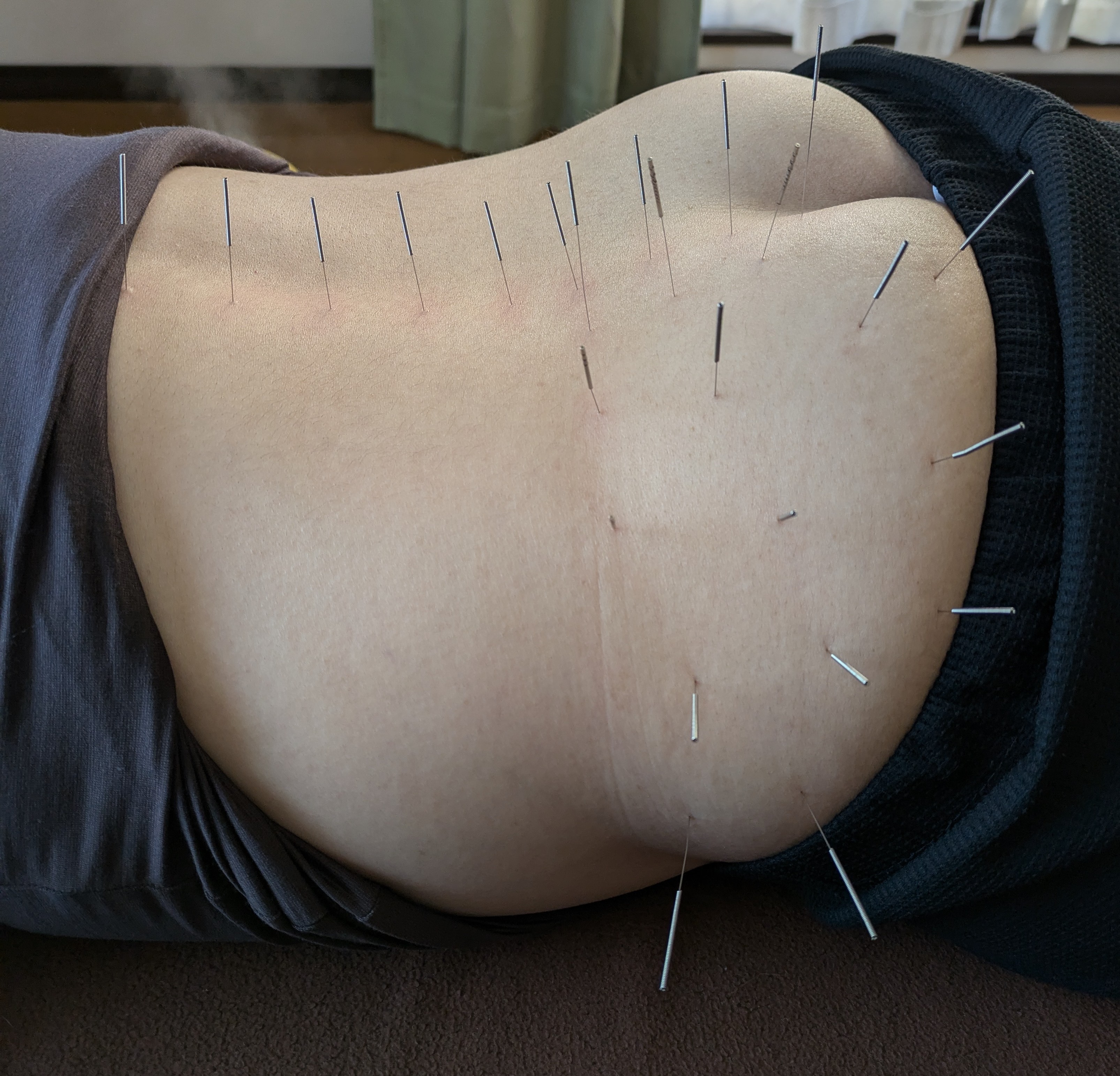 世田谷鍼灸ルーム 【新規】スタンダードコース（初診料2,000円　施術料7000円）のメニュー画像