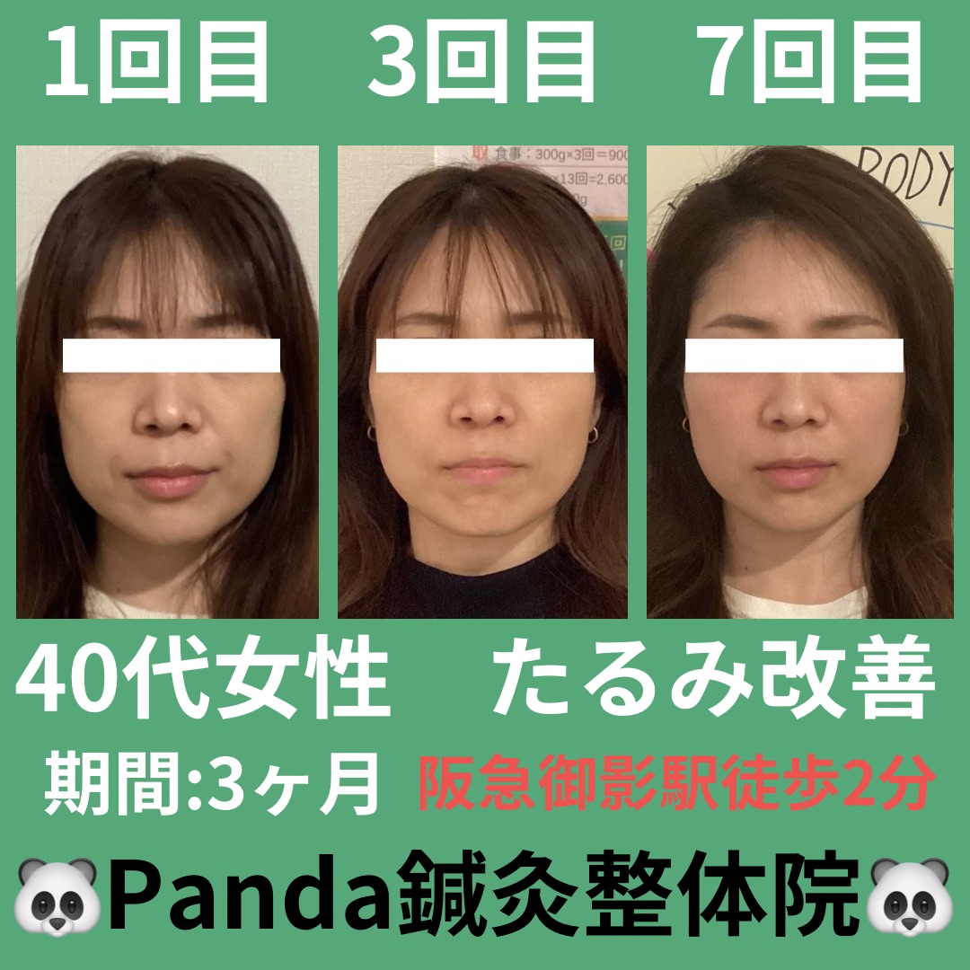 Panda鍼灸整体院(パンダ鍼灸整体院）ダイエット・美容鍼・育毛鍼 【5月残2名】リフトアップ特化型プレミアム美容鍼　３ヶ月コース 初回体験 ¥5980のメニュー画像