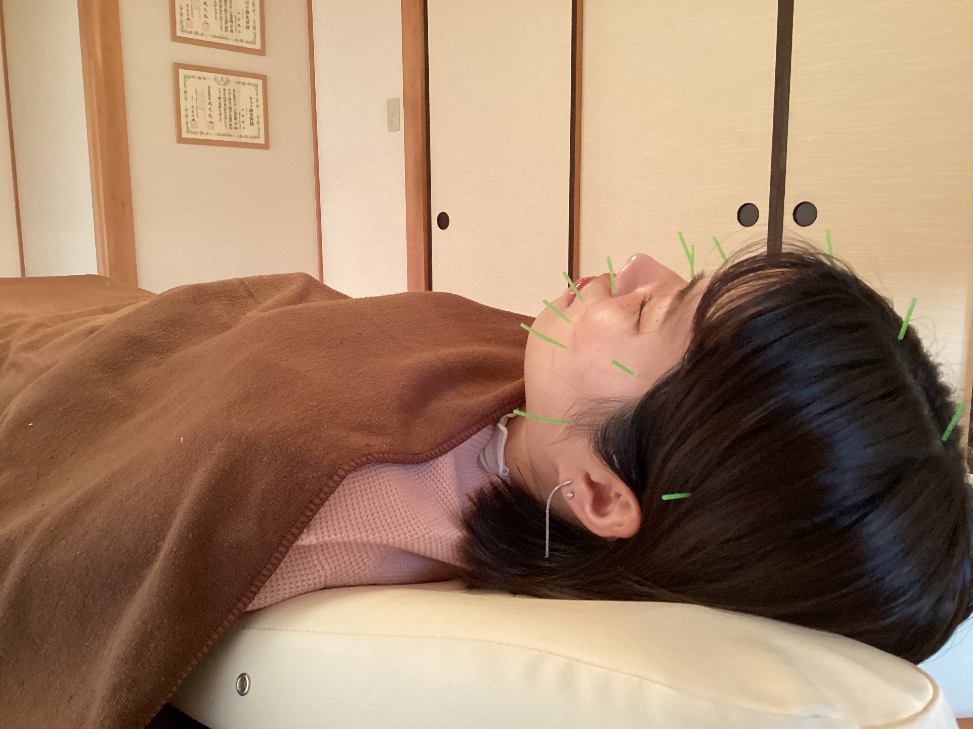 なかむら鍼灸院 [1名様限定]リフトアップ・眼精疲労改善美容鍼(ヘッドスパ付き）5000円→1980円のメニュー画像