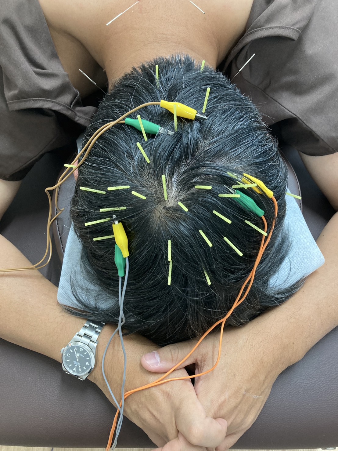 ふじおか鍼灸院 男性薄毛育毛鍼灸のメニュー画像