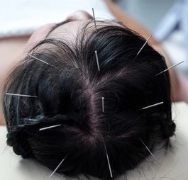 ふじおか鍼灸院 育毛鍼（抜け毛・薄毛の改善、髪にハリ・コシを与える）のメニュー画像