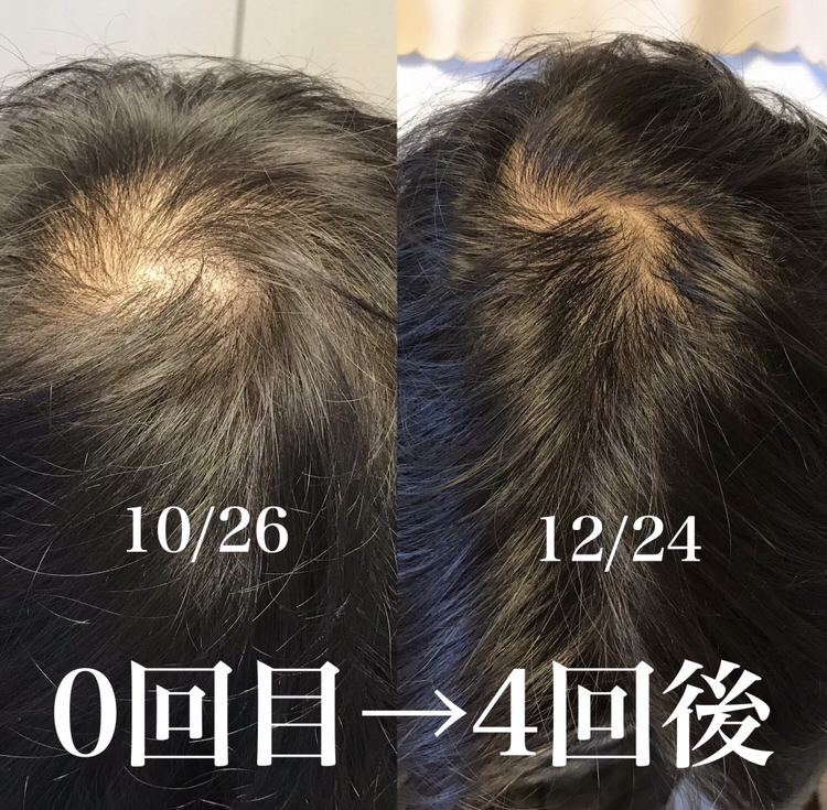 中野区野方鍼灸院のむち鍼 【毎月5名限定】薄毛に育毛鍼（初回）AGA治療であまり変化がなかった・副作用が気になる男性に大人気。女性にも利用いただいてます。のメニュー画像