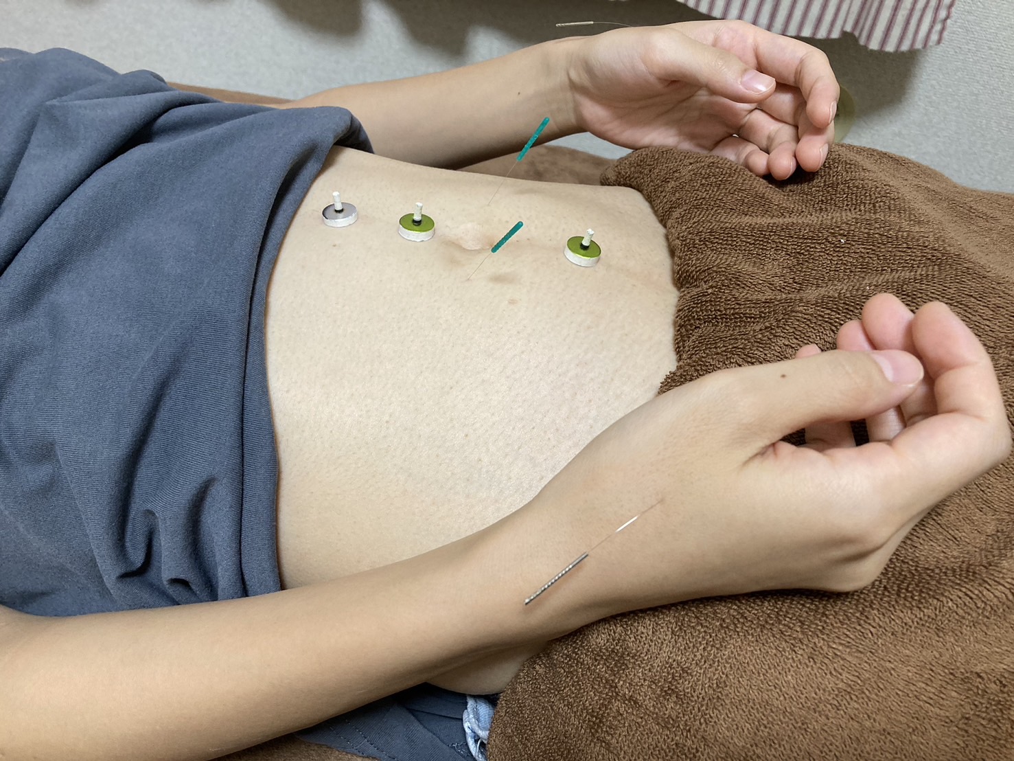 ふじおか鍼灸院 痔鍼灸施術    ※患部に触れない鍼灸ならではの遠隔治療のメニュー画像