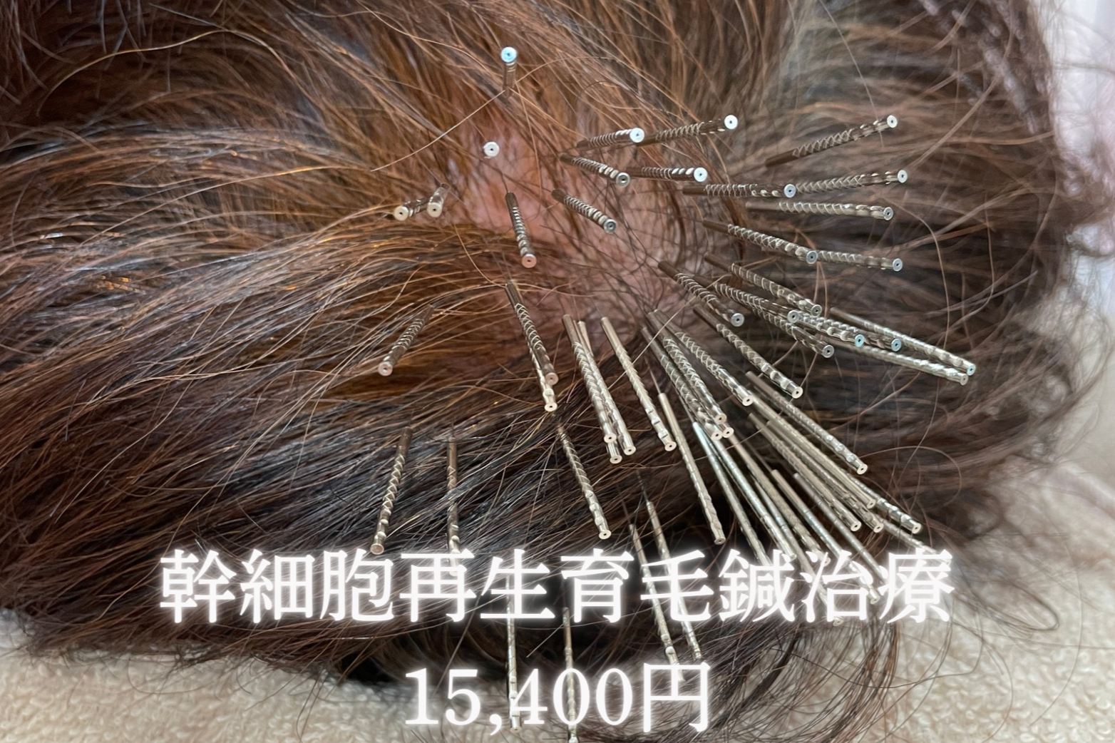 女性専門きよもと鍼灸院 【髪のお悩みなら】幹細胞再生育毛鍼治療コースのメニュー画像
