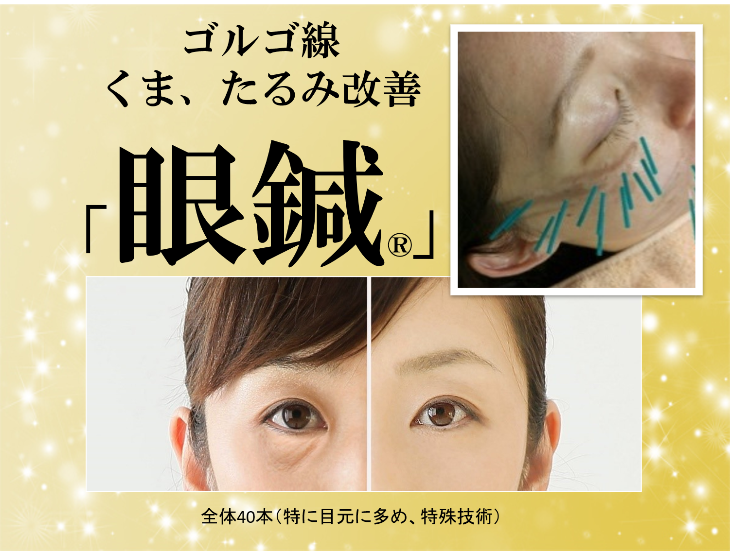 鍼灸 整体　HARIS（ハリス：大阪本院） 目元のたるみ改善コース「眼鍼®」（目元多め）のメニュー画像