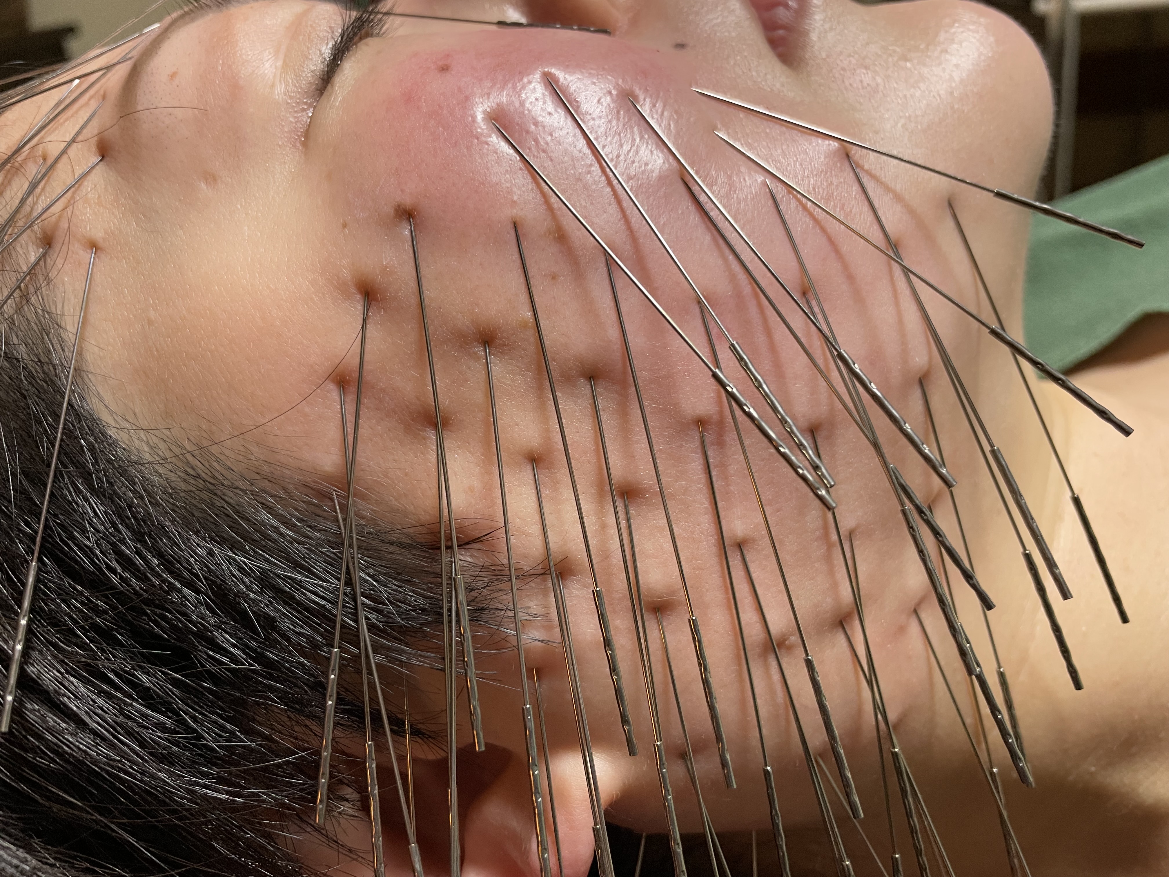 からほり　野の花堂　かつらぎ町出張所 【新規の方】ルート 鬼 美容鍼 60分のメニュー画像