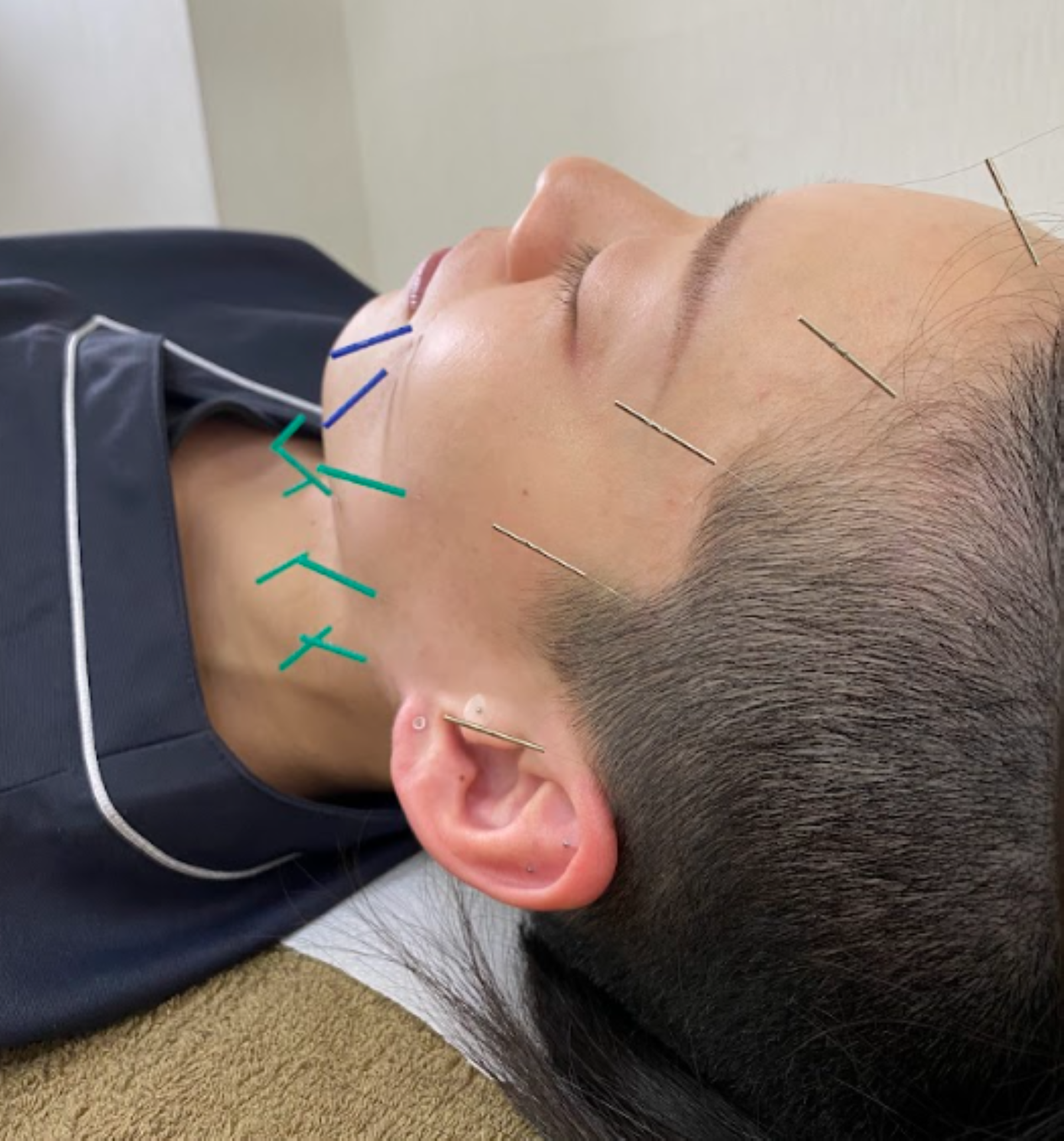 はま整体院 美容鍼【オーダーメイド施術】のメニュー画像