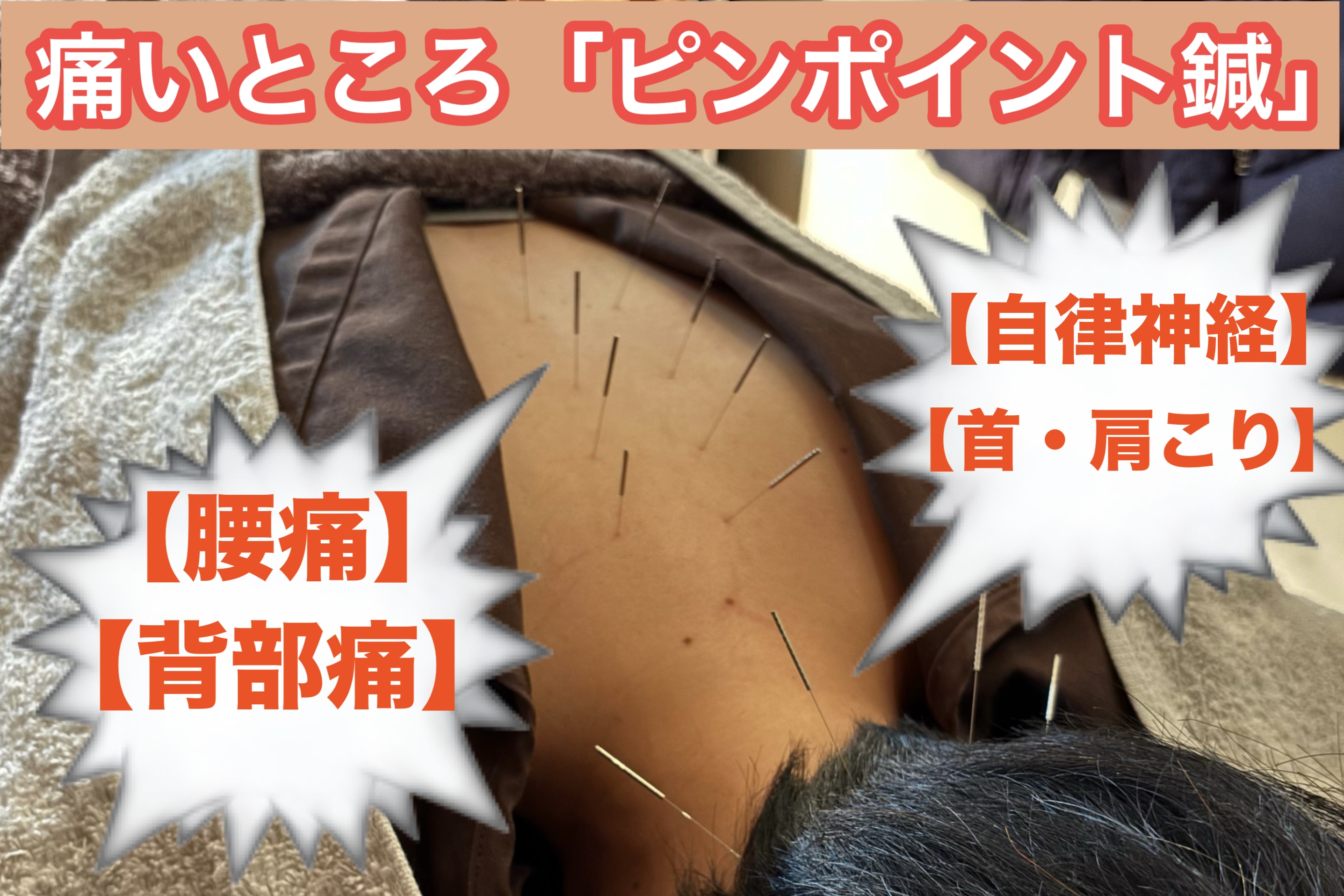 アスモット鍼灸整体院 痛いところ「ピンポイント鍼」のメニュー画像