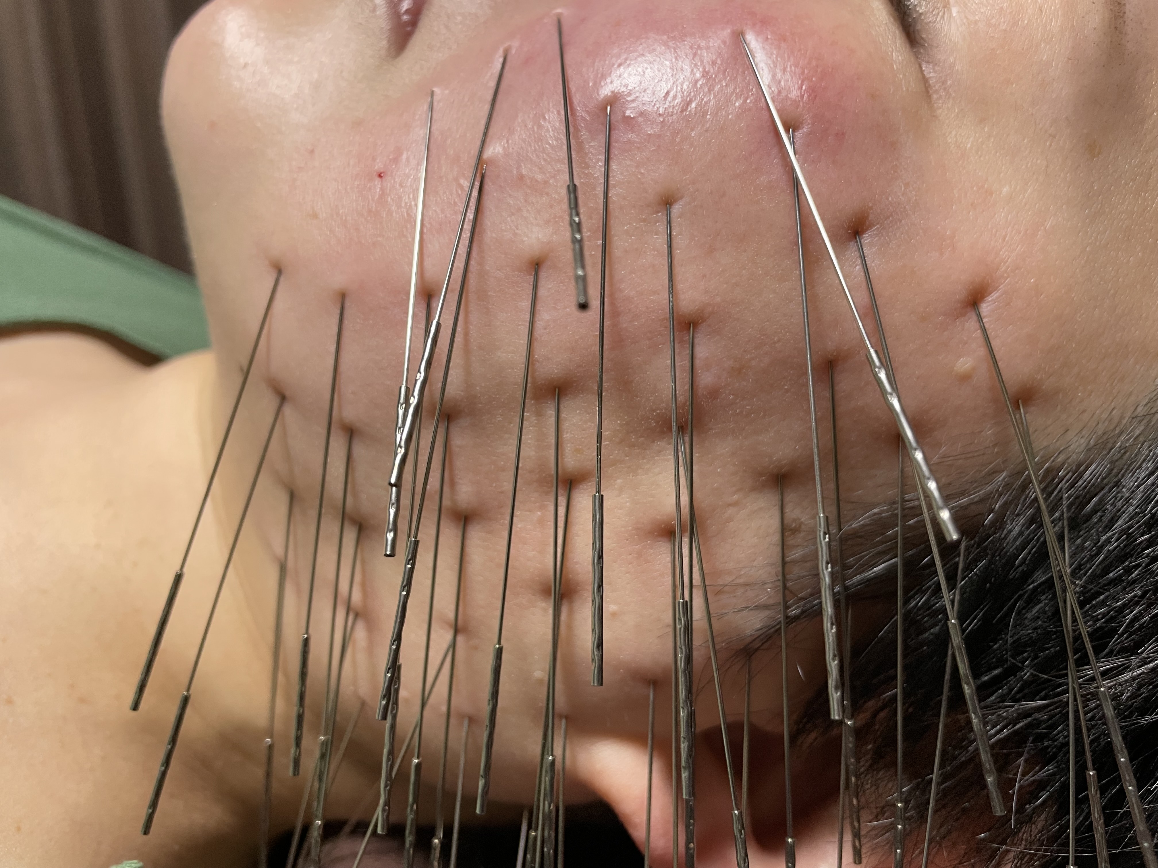 はり処 松陽堂 谷町六丁目　ルート治療　　生駒出張所  【新規の方】ルート 鬼 美容鍼 60分のメニュー画像
