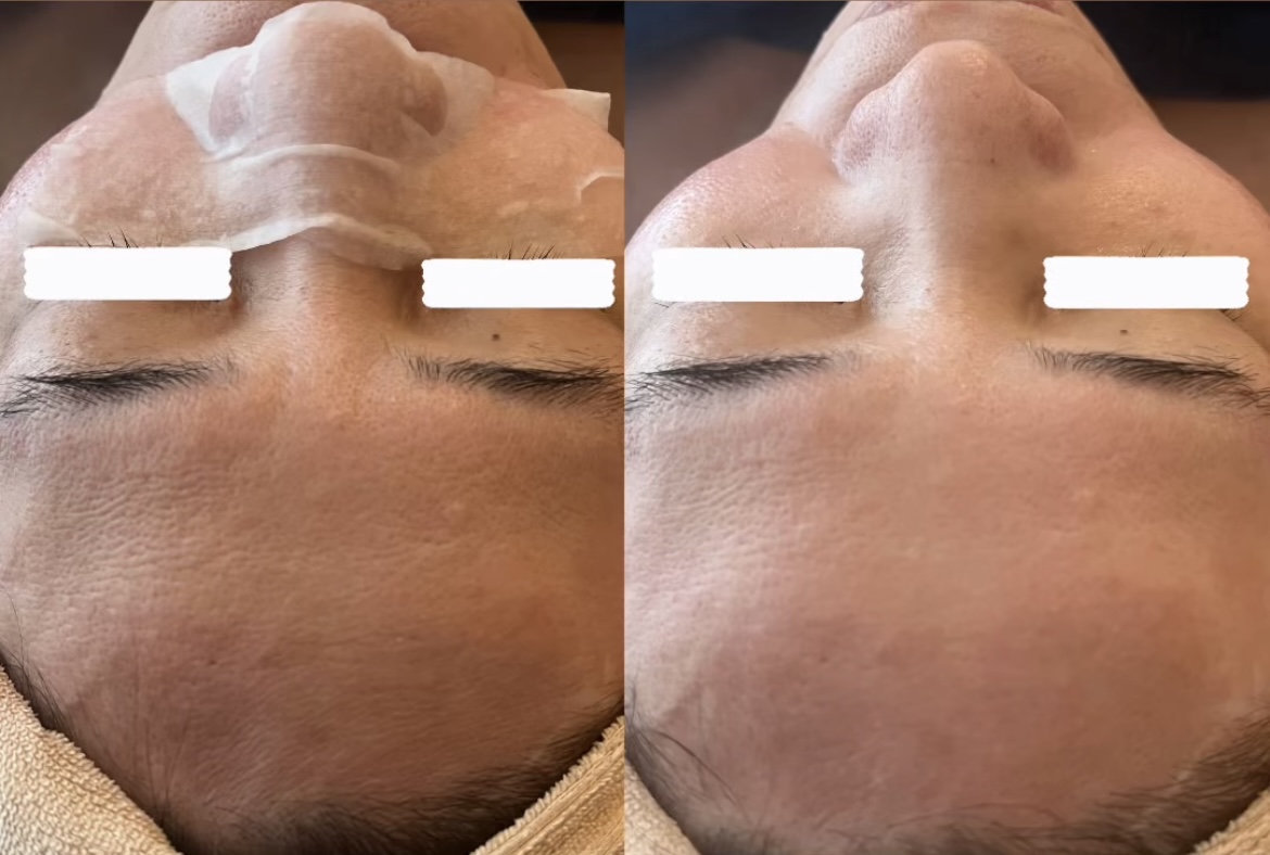 那覇鍼灸サロンrepos［ルポ］ 炭酸ガスパック【ヒト幹細胞配合】のメニュー画像