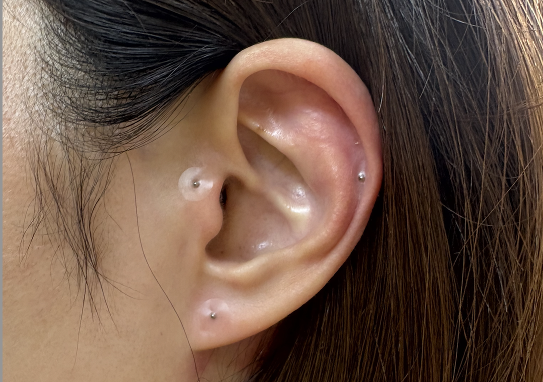 ルート治療専門　ながえ鍼灸院 耳鍼（花粉症、各種アレルギー、ダイエット鍼、腰痛、肩こり、顎の痛み）のメニュー画像