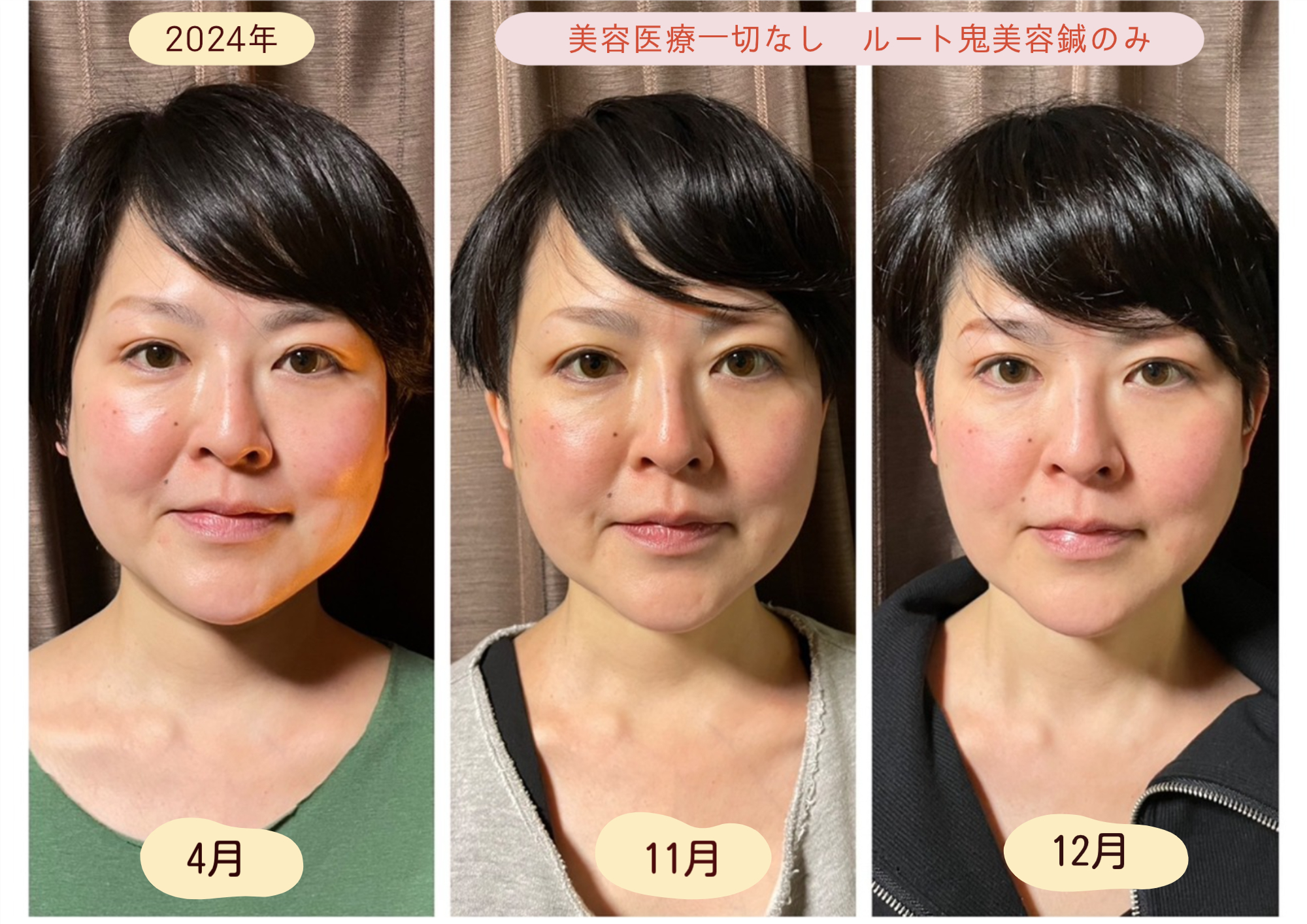 からほり　野の花堂 ルート  美容鍼  30分のメニュー画像