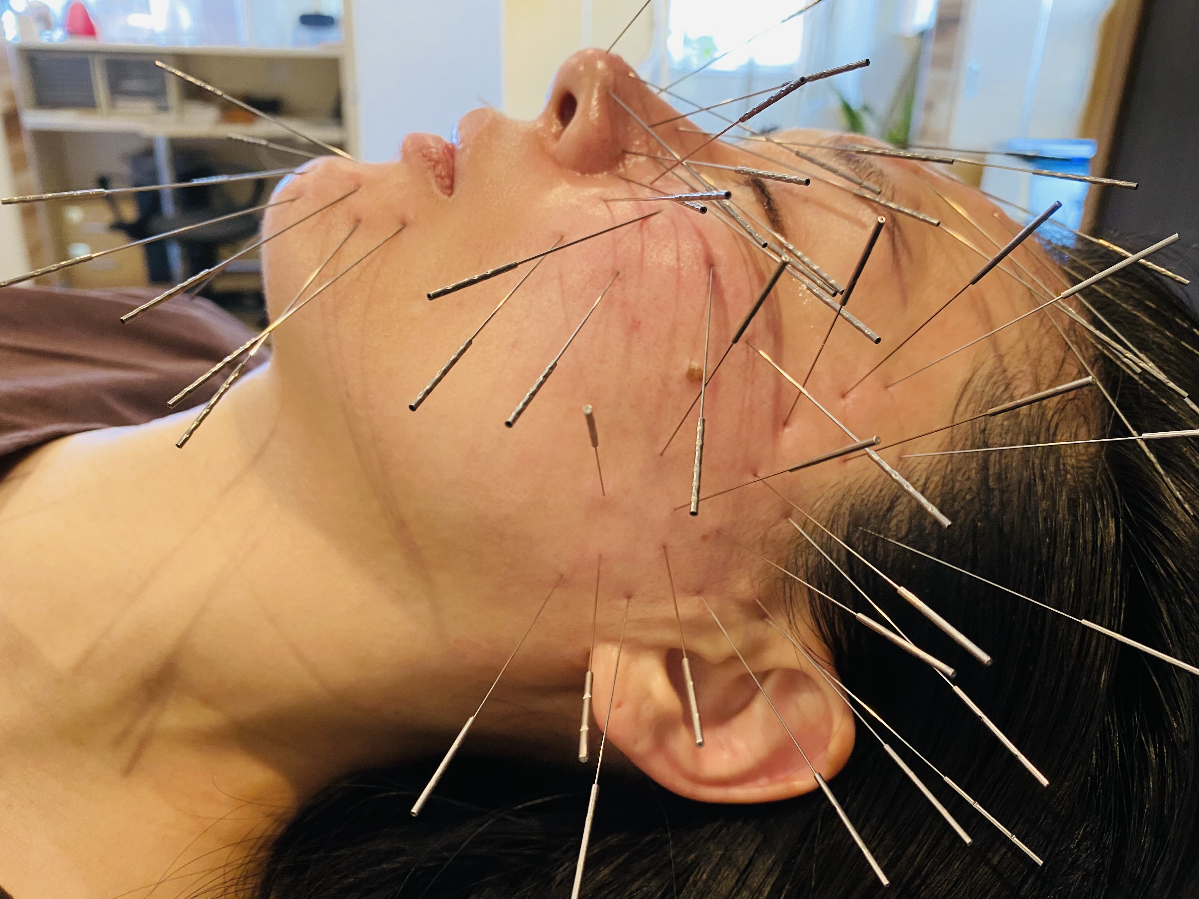 長﨑鍼療院【ルート治療認定院】 ルート鬼美容鍼のメニュー画像