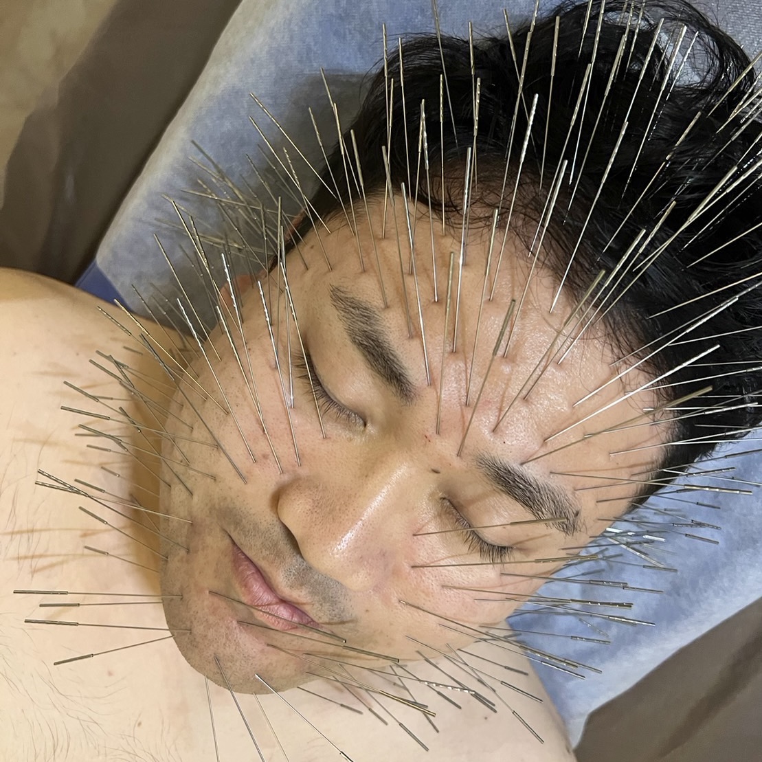 はり・きゅう KURODA応神 美容鍼のメニュー画像