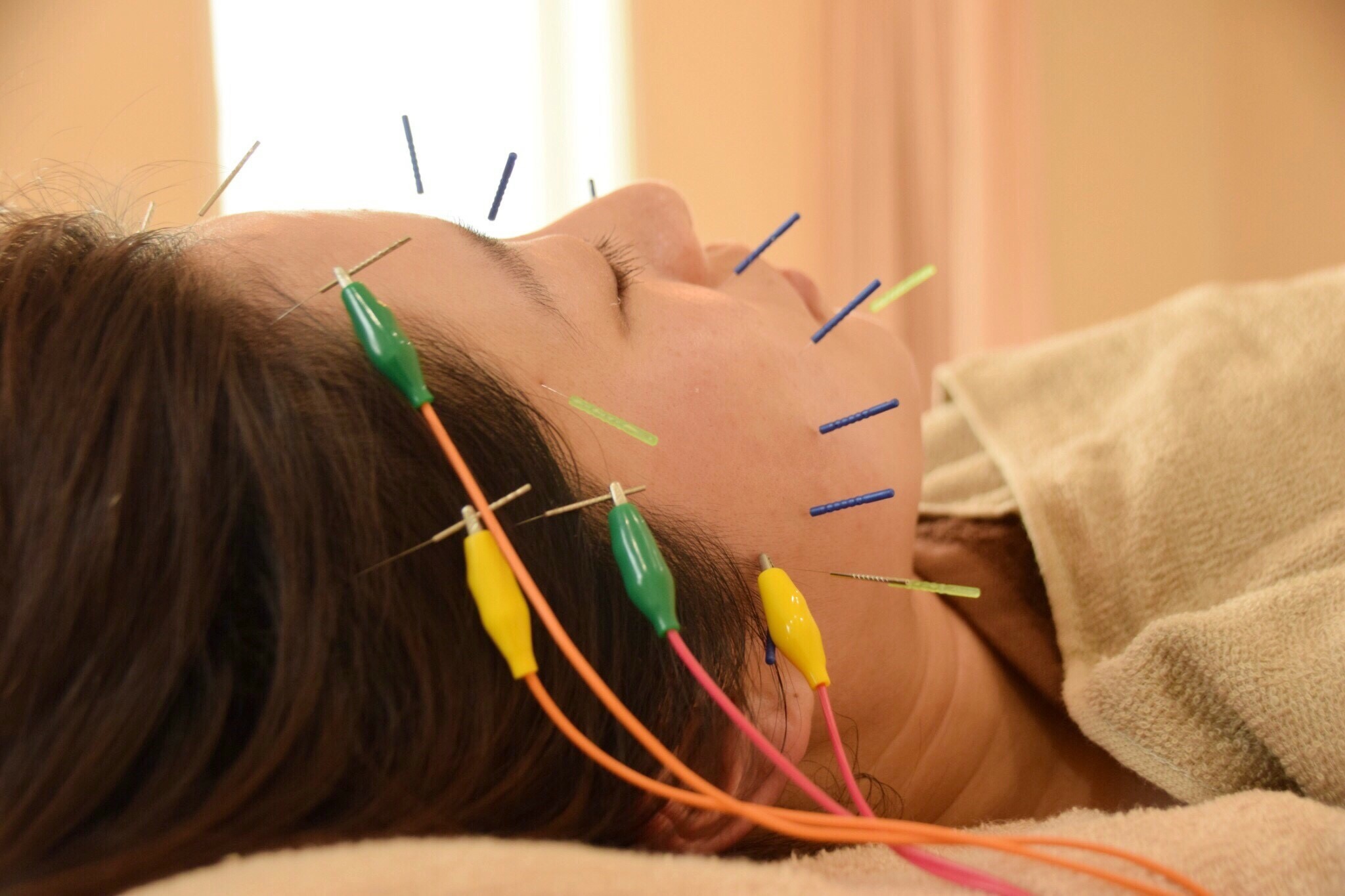 須賀川おれんぢ鍼灸院 美容鍼灸プレミアムのメニュー画像