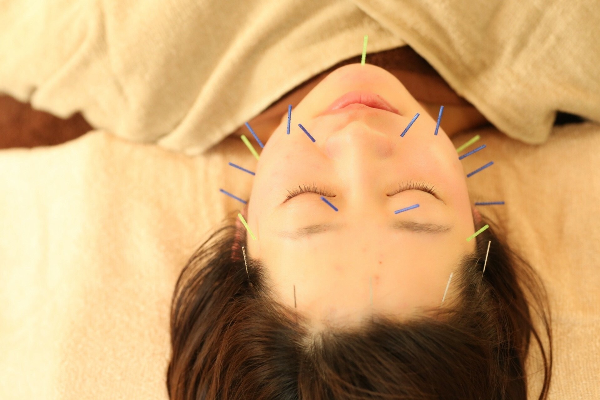 須賀川おれんぢ鍼灸院 美容鍼灸のメニュー画像