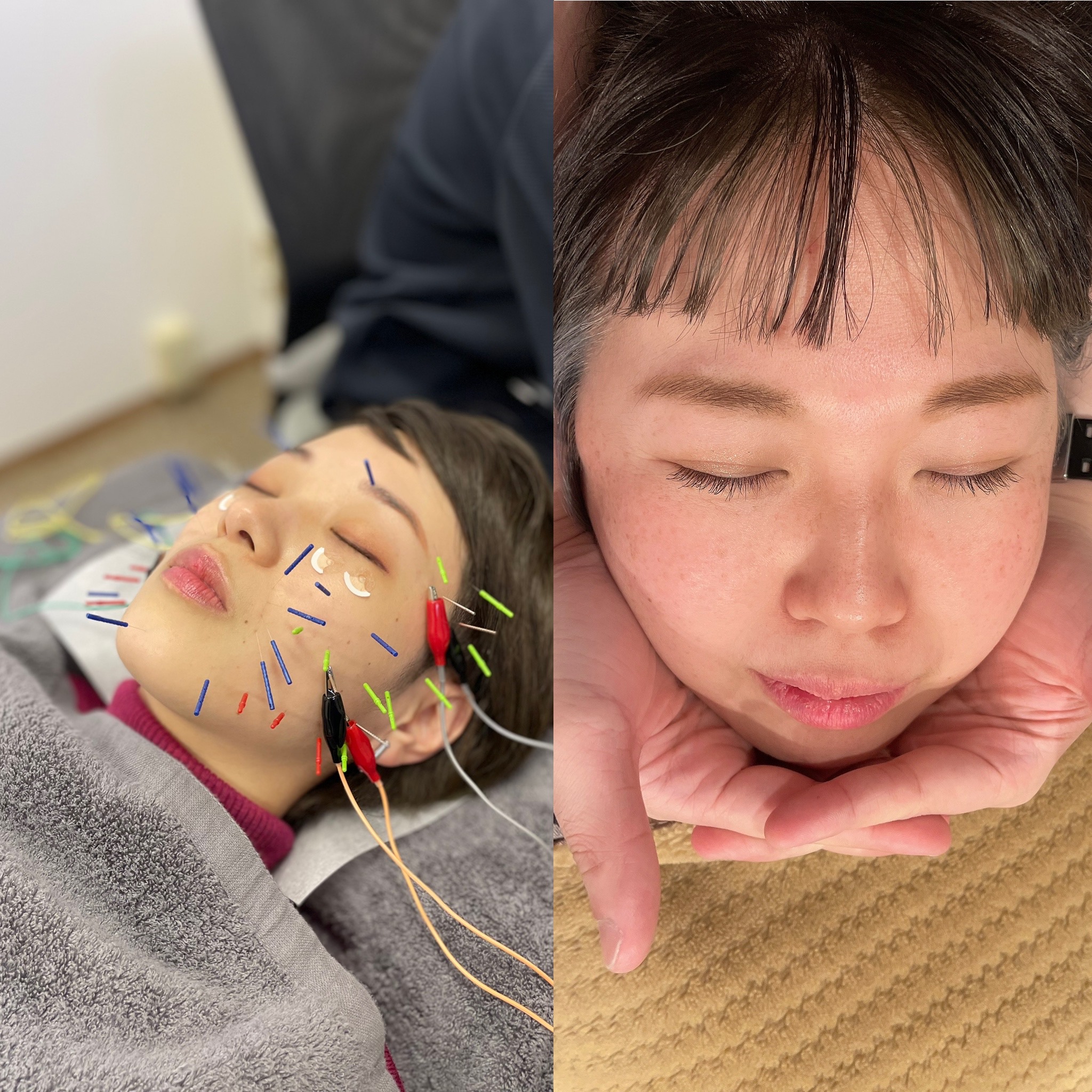美容鍼サロン　harry's N 美容鍼×小顔矯正のメニュー画像