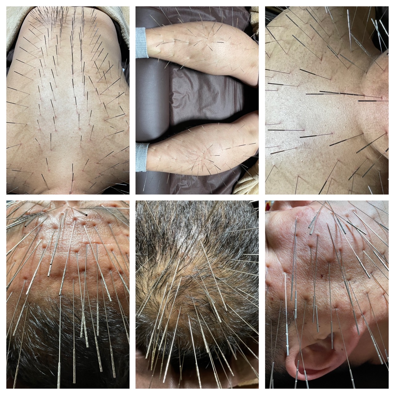 からほり　野の花堂 ルート鍼 90分 特別治療のメニュー画像