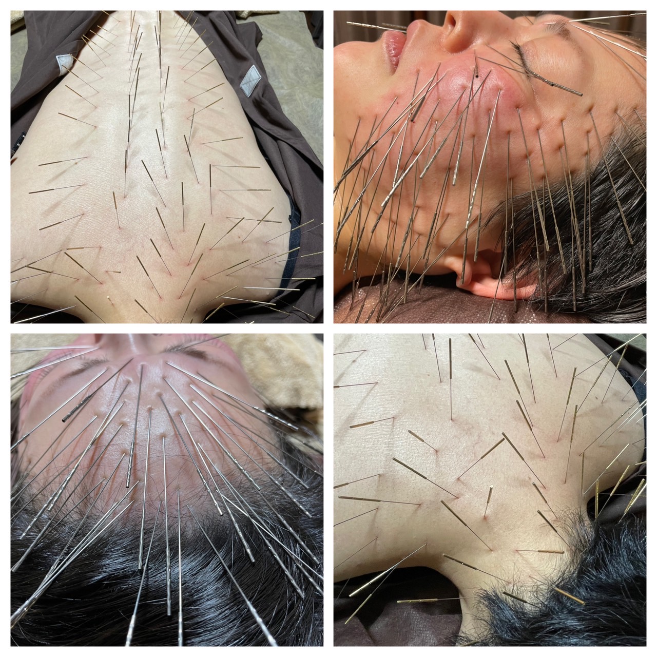 からほり　野の花堂 ルート鍼 60分  標準治療のメニュー画像