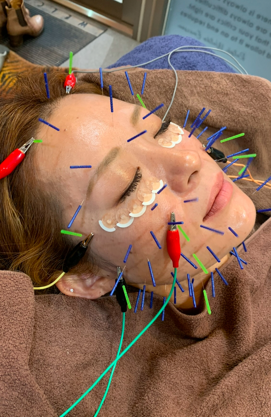 美鍼堂 美鍼小顔アンチエイジングのメニュー画像