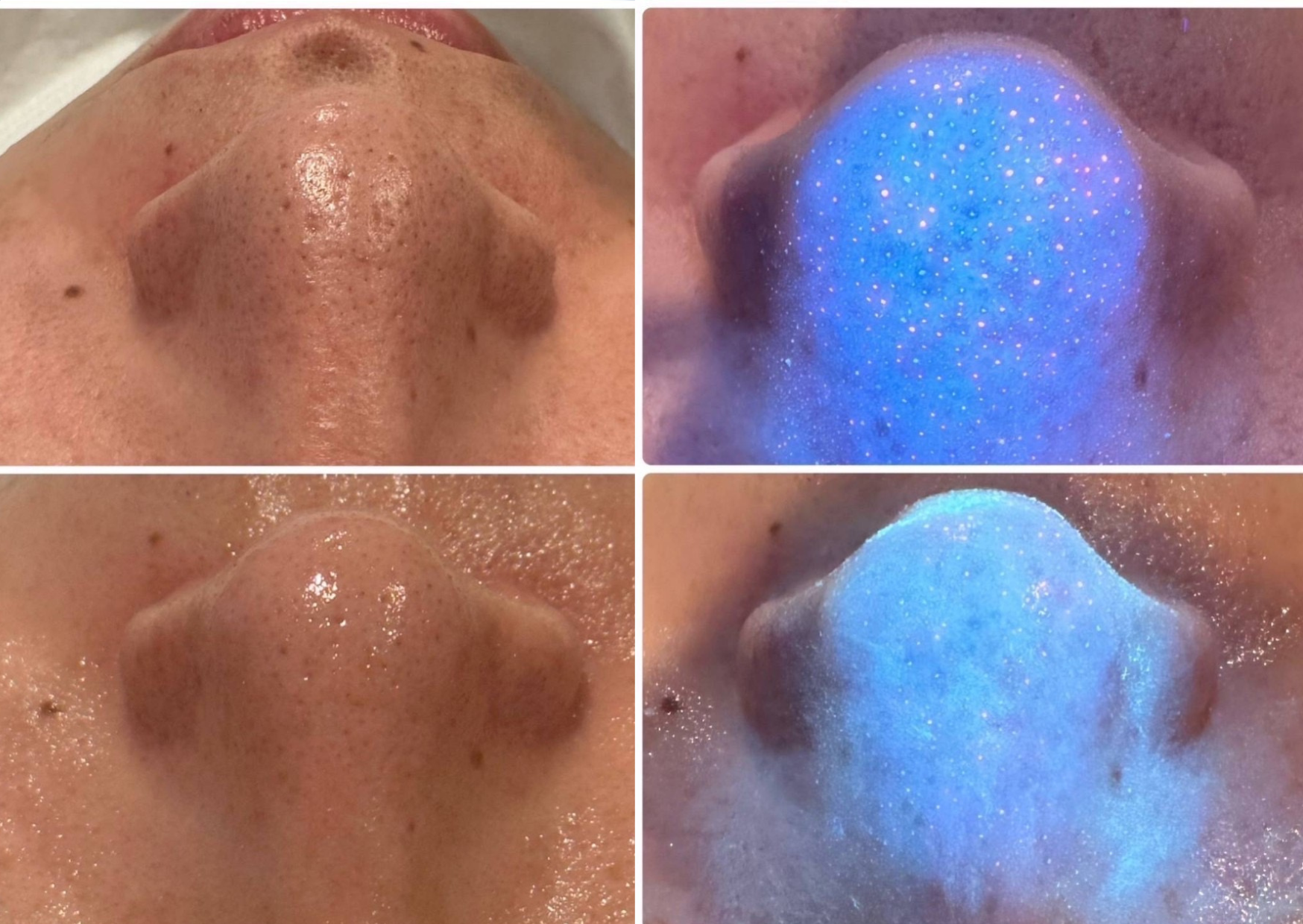 那覇鍼灸サロンrepos［ルポ］ 毛穴洗浄【ハイドラシャイン】美容鍼とのセットのメニュー画像