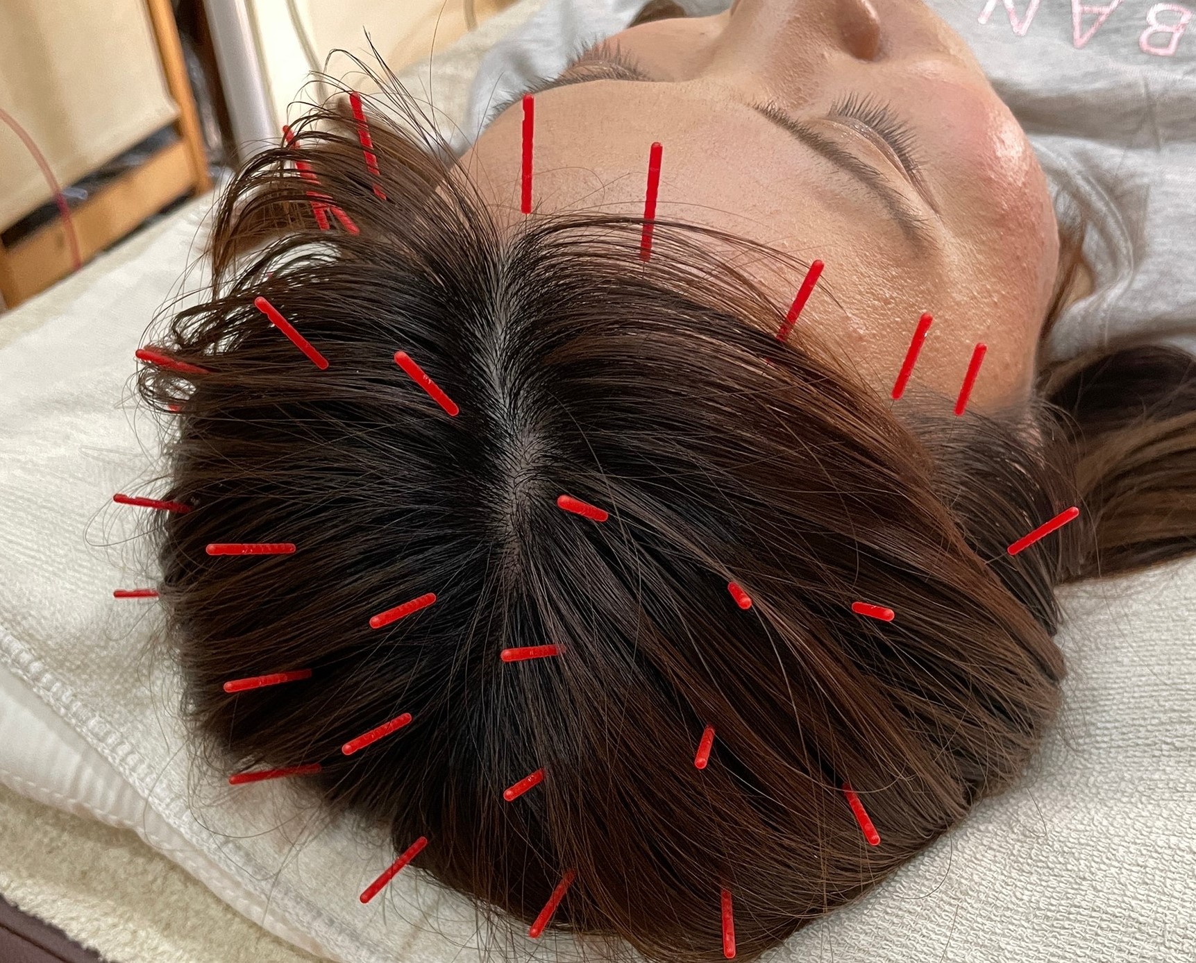 鍼灸マッサージ・美容鍼・ダイエット　藤井治療院 美髪鍼のメニュー画像