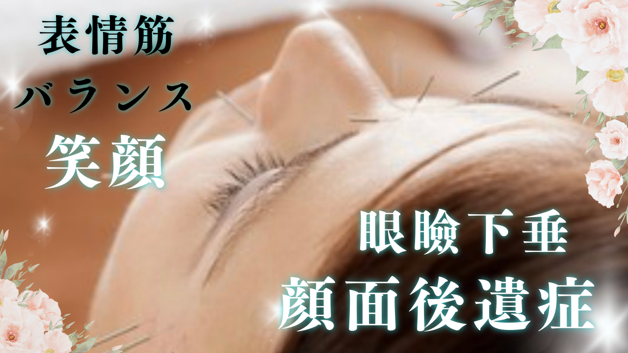 unはさみとおきゅうときどきおはり【アン】 【顔面神経麻痺】鍼灸治療のメニュー画像