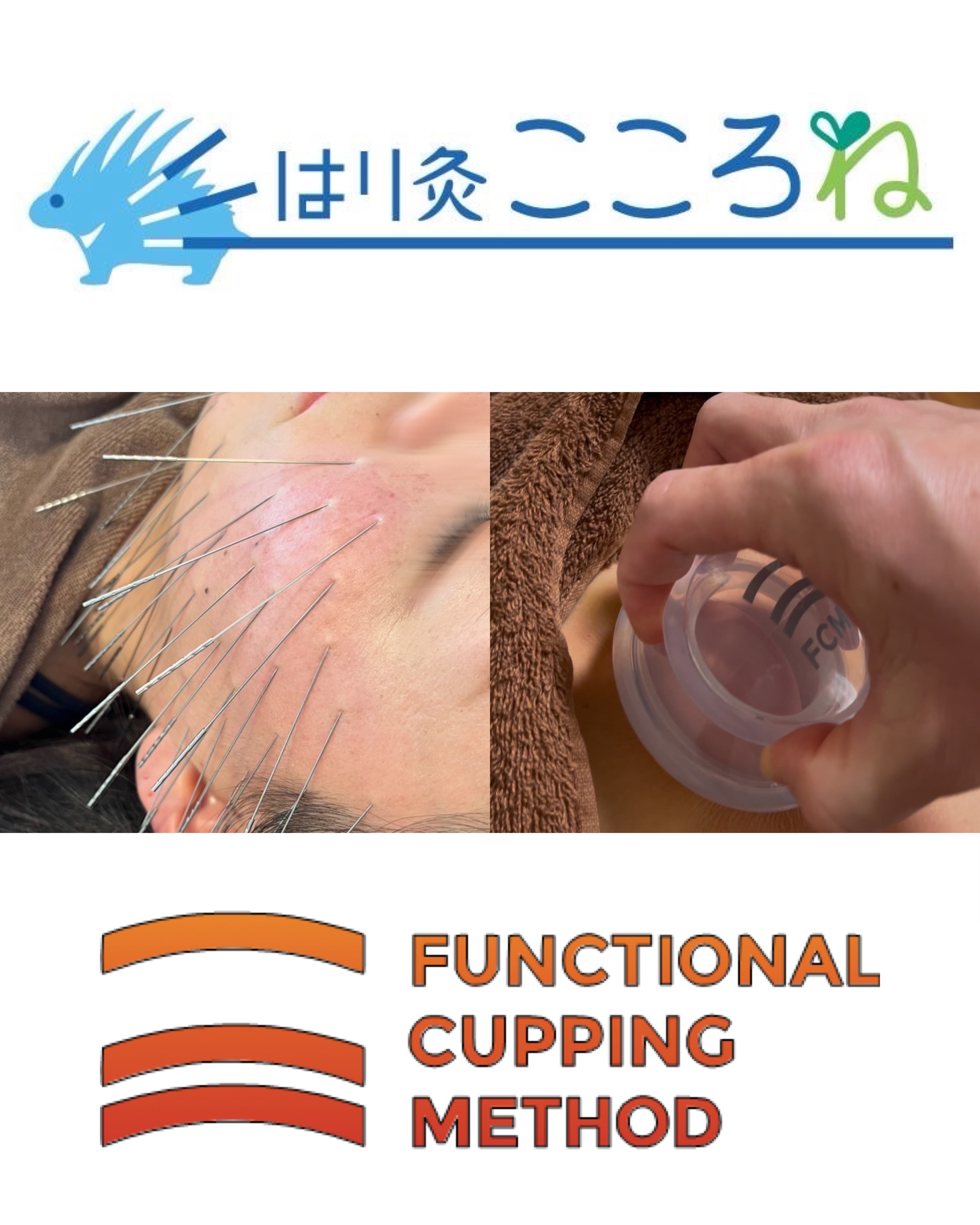 はり灸こころね はり (トリガーポイント)×もみほぐし×FCMカッピング / 90分のメニュー画像