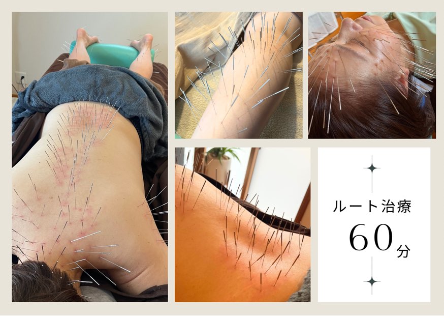 鍼処　陽和　-fuwari-     　　（旧：新栄はりきゅう院） ルート治療60分のメニュー画像