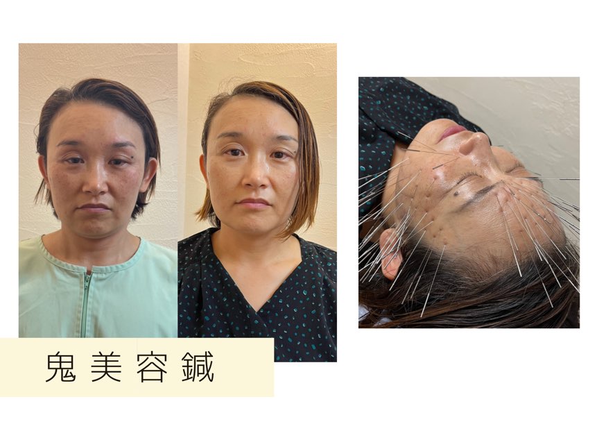 鍼処　陽和　-fuwari-     　　（旧：新栄はりきゅう院） 鬼美容鍼のメニュー画像