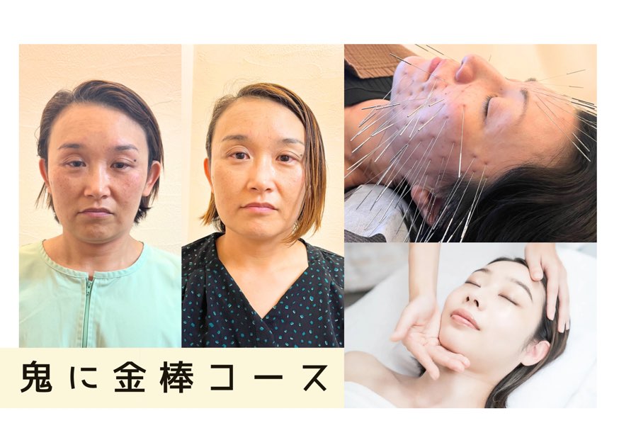 鍼処　陽和　-fuwari-     　　（旧：新栄はりきゅう院） 鬼に金棒コースのメニュー画像