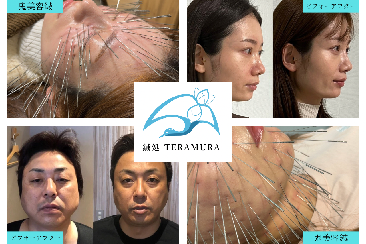 鍼処TERAMURA　山口県下関市　ルート治療認定院 ルート鬼美容鍼　スタンダードのメニュー画像