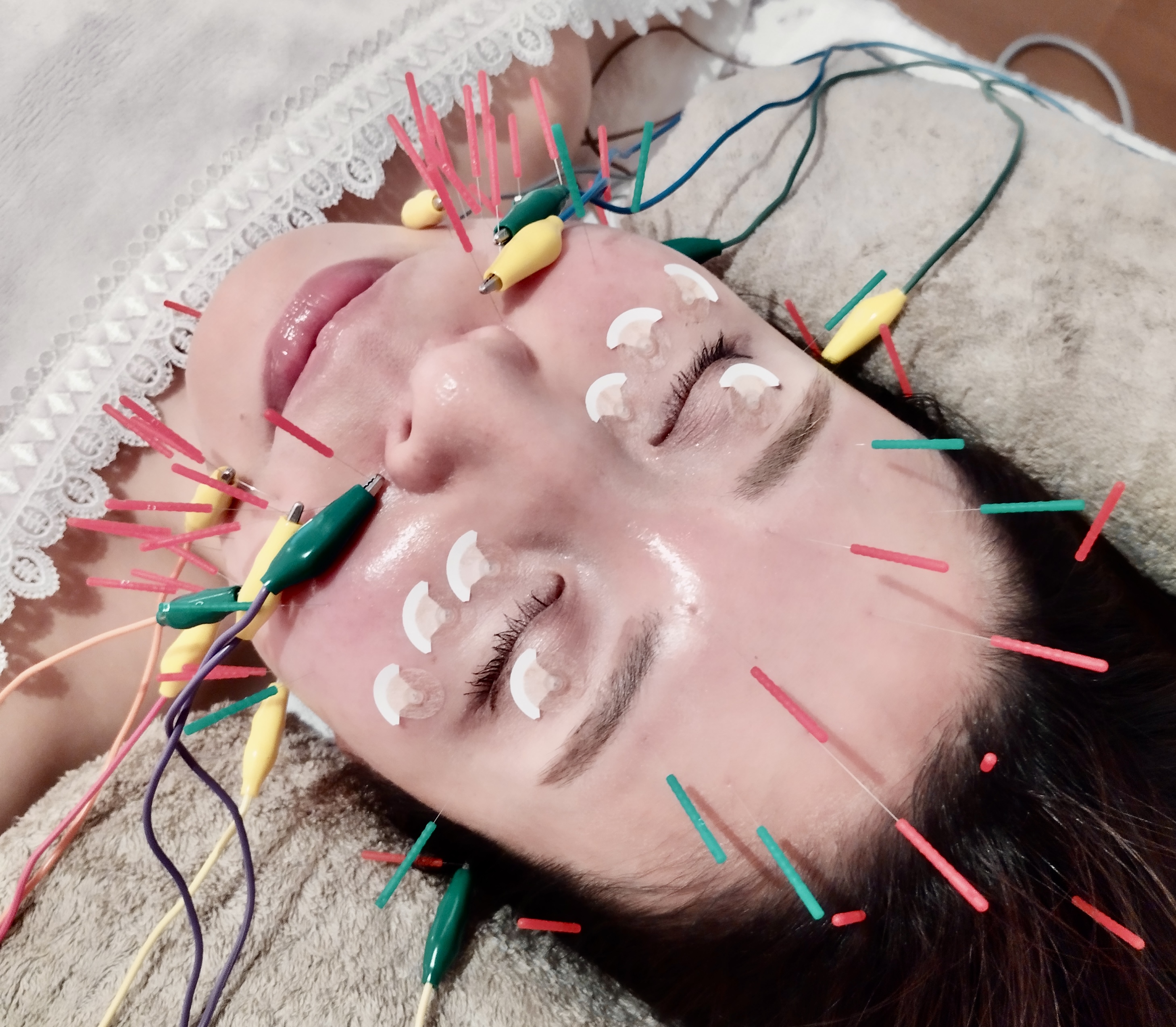 美容鍼灸サロン 漢方美人 リフトアップ美容鍼&全身鍼灸【美容鍼+電気】フェイシャル かっさ 全身鍼灸 首肩頭皮のマッサージ付きのメニュー画像