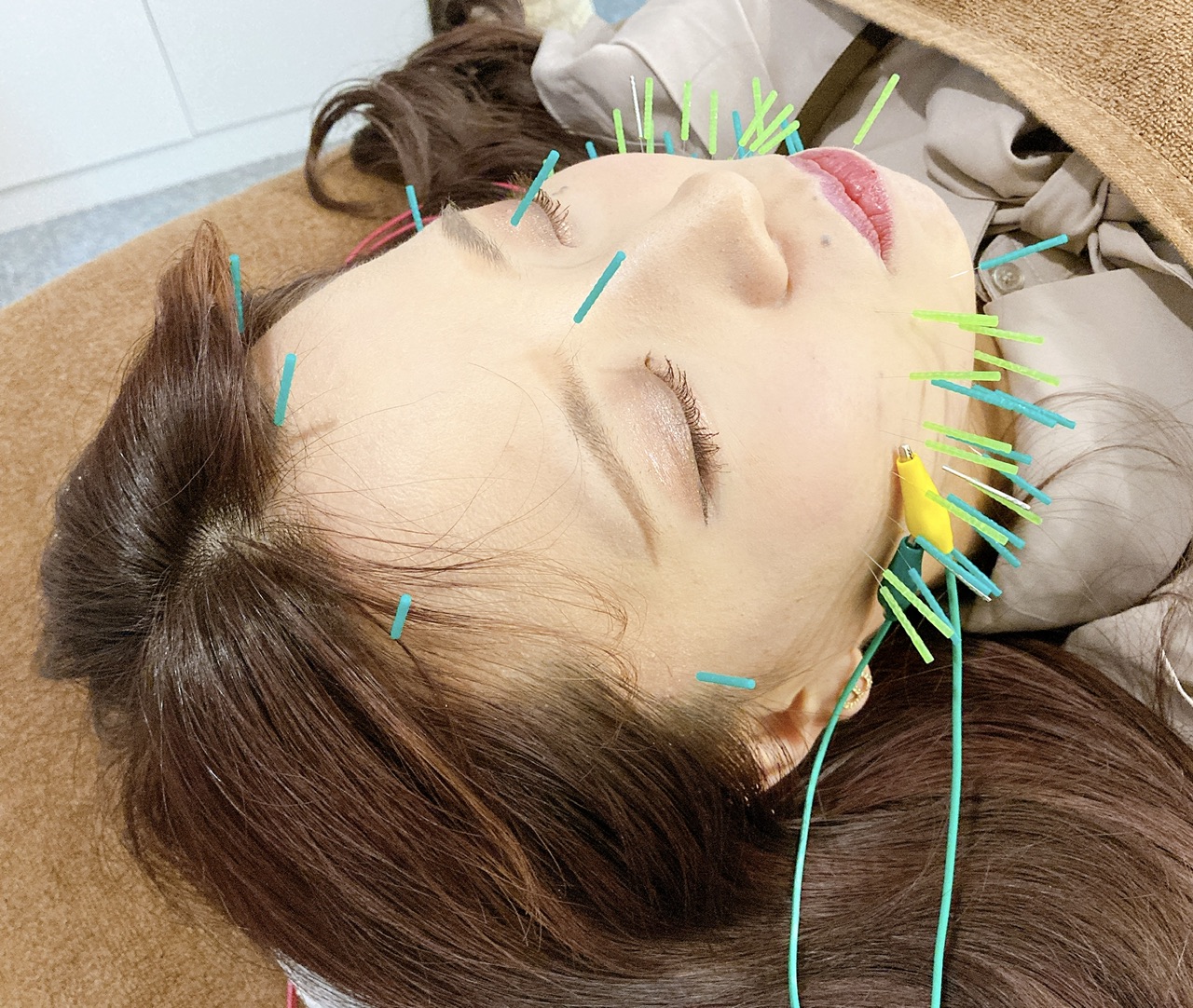 aime鍼灸院|江坂店|台湾鍼灸|女性専用| 【初回】経絡美容鍼+頭皮鍼のメニュー画像